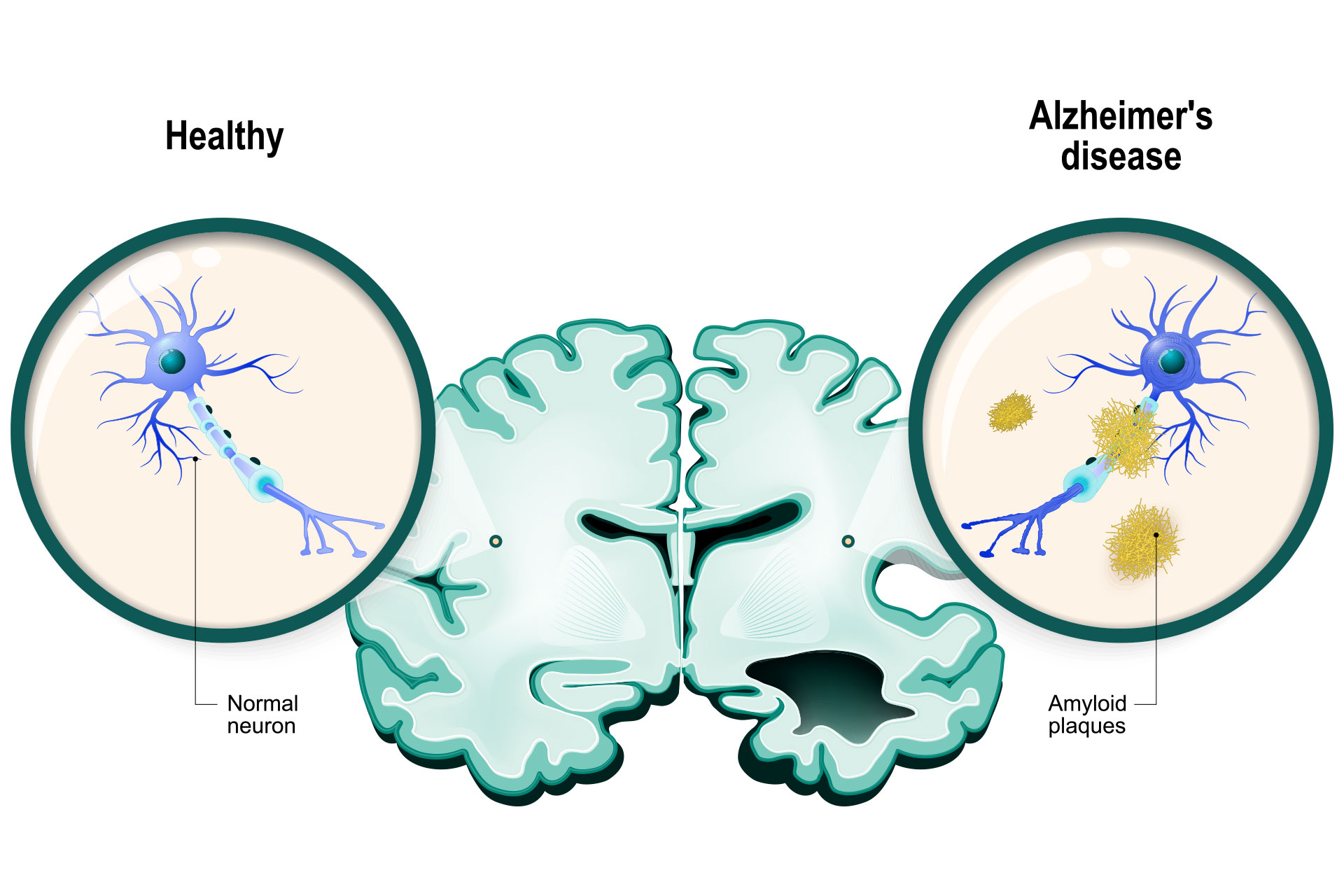 Alzheimer's graphic