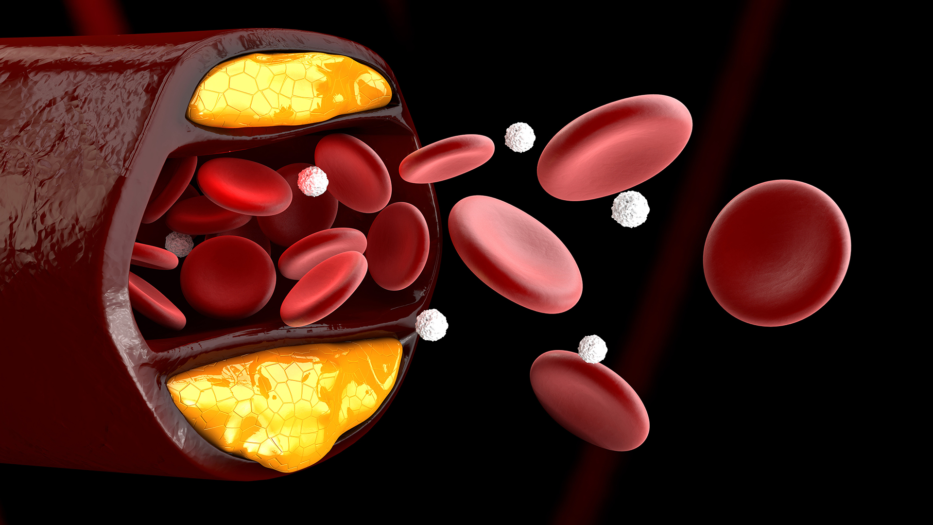 Graphic of an artery with cholesterol