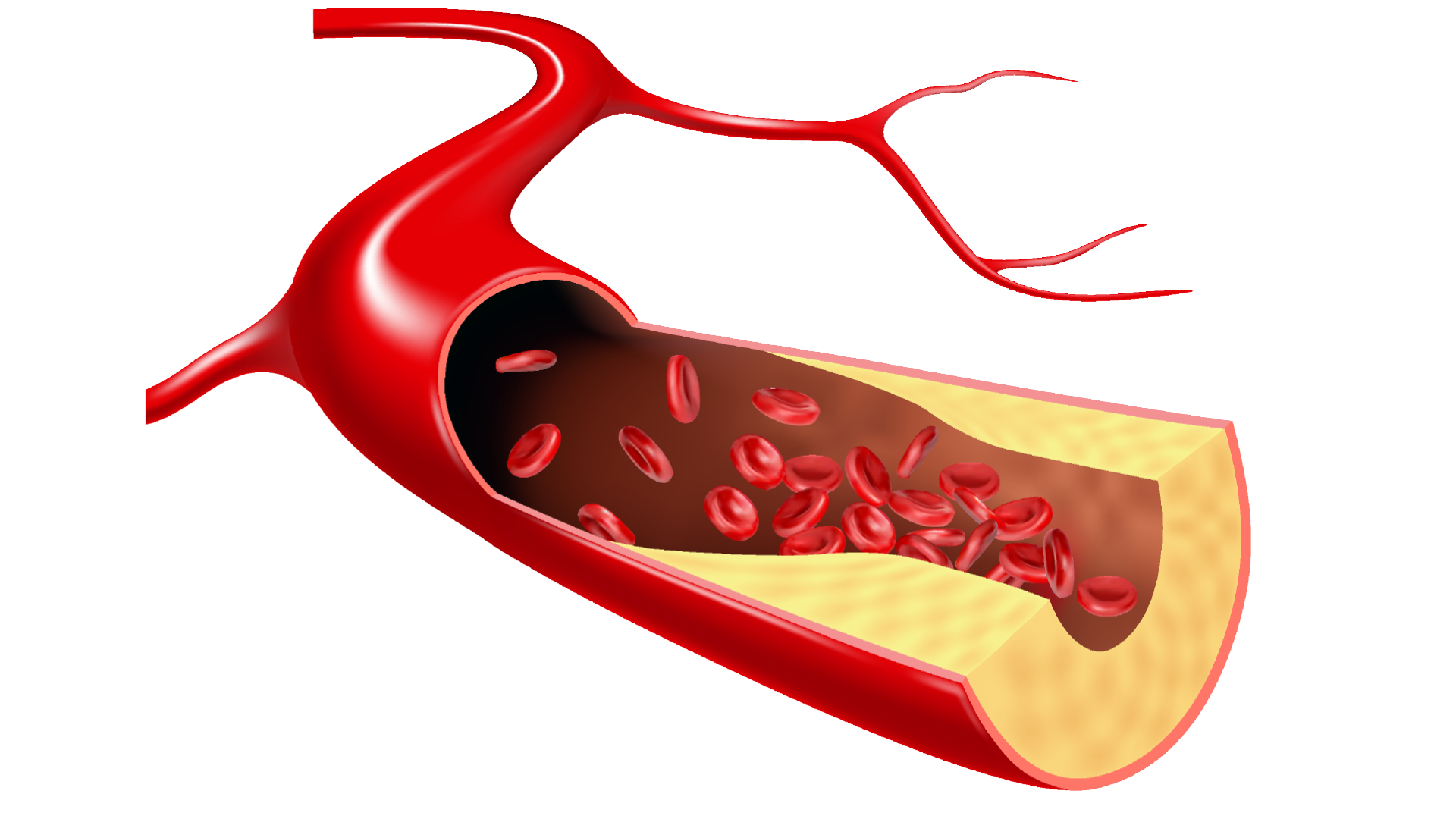 atherosclerosis stages