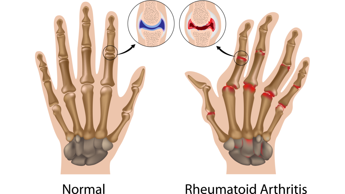 Rheumatoid Arthritis Awareness Day Signature Health Services
