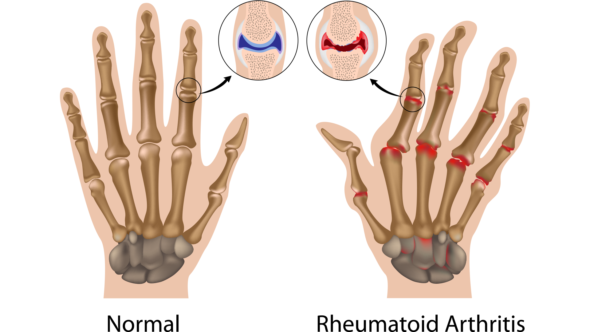 Arthritis graphic
