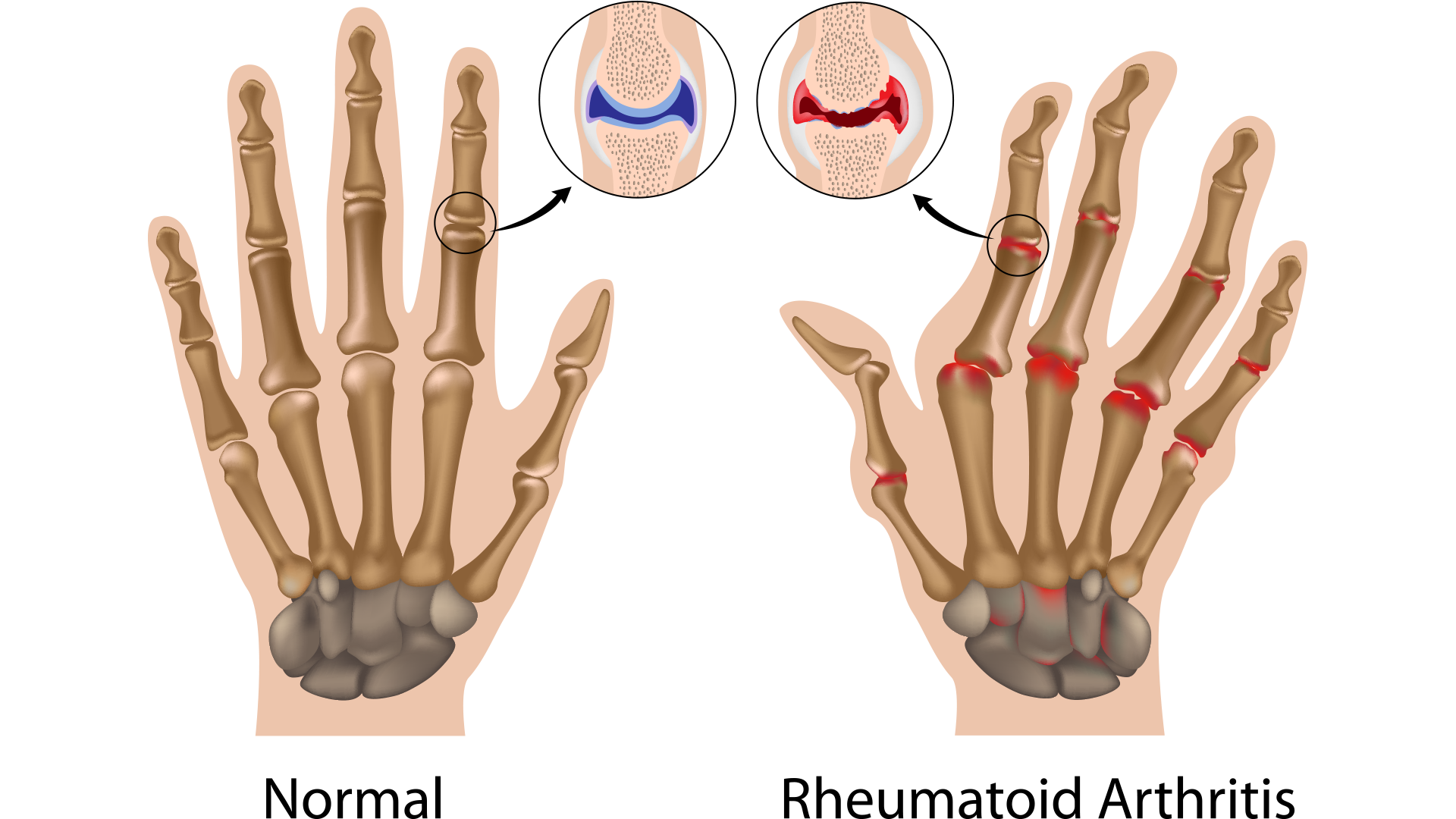 Hero-Arthritis-Wrist-Pain-Graphic rheumatoid arthritis graphic