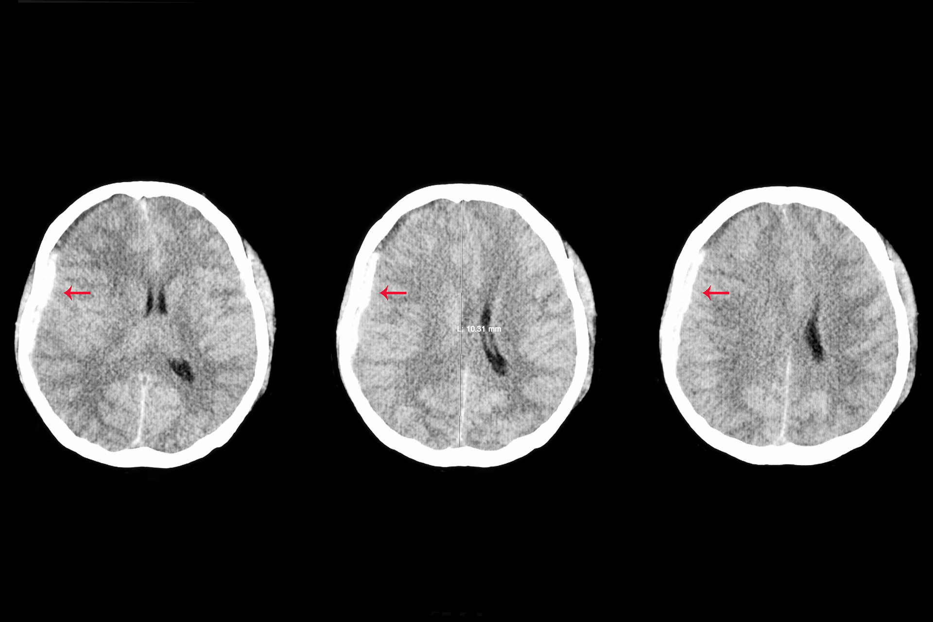 picture of three brains showing brain injury