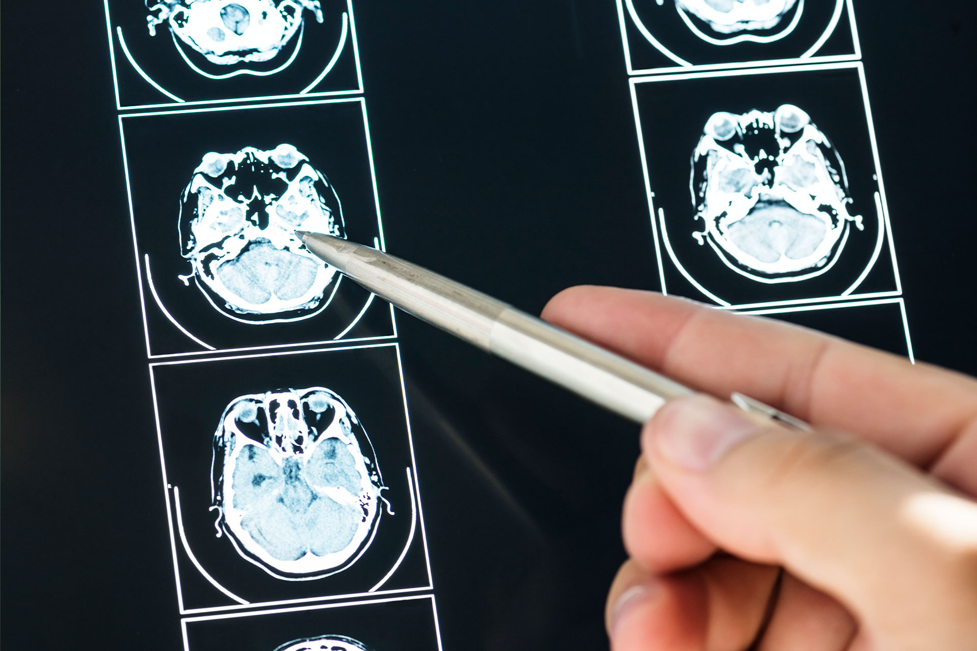 Hero-Brain-MRI