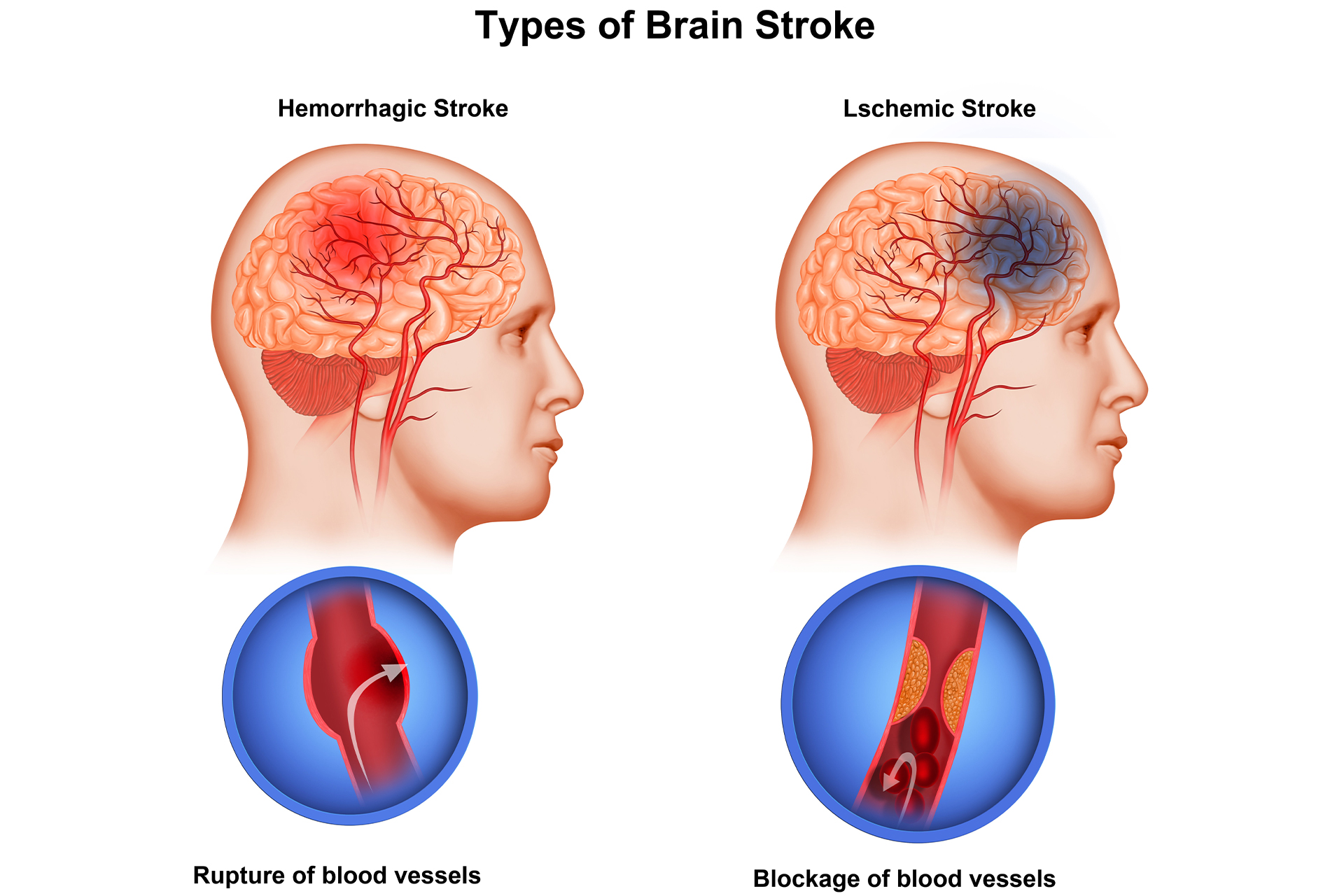 types of brain stokes
