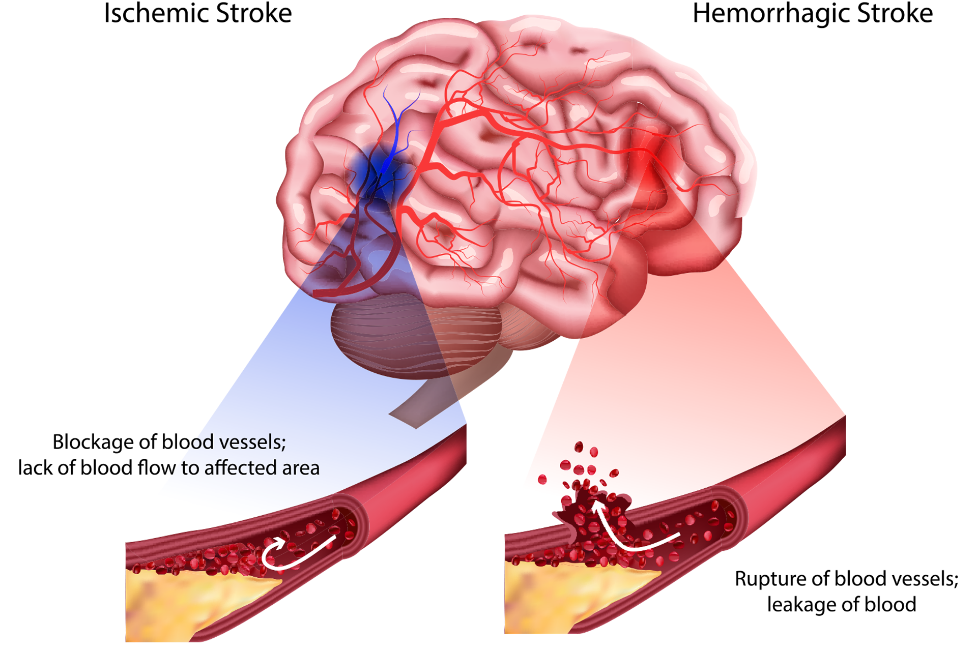 graphic about cva and strokes