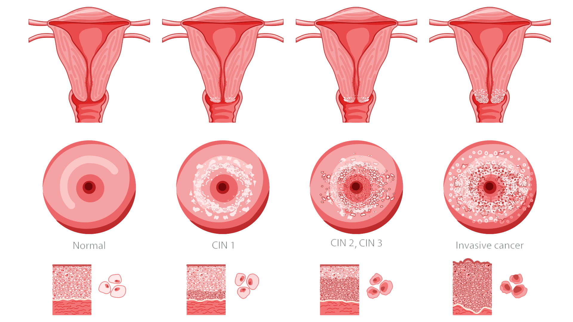 diagram of cervical cancer 