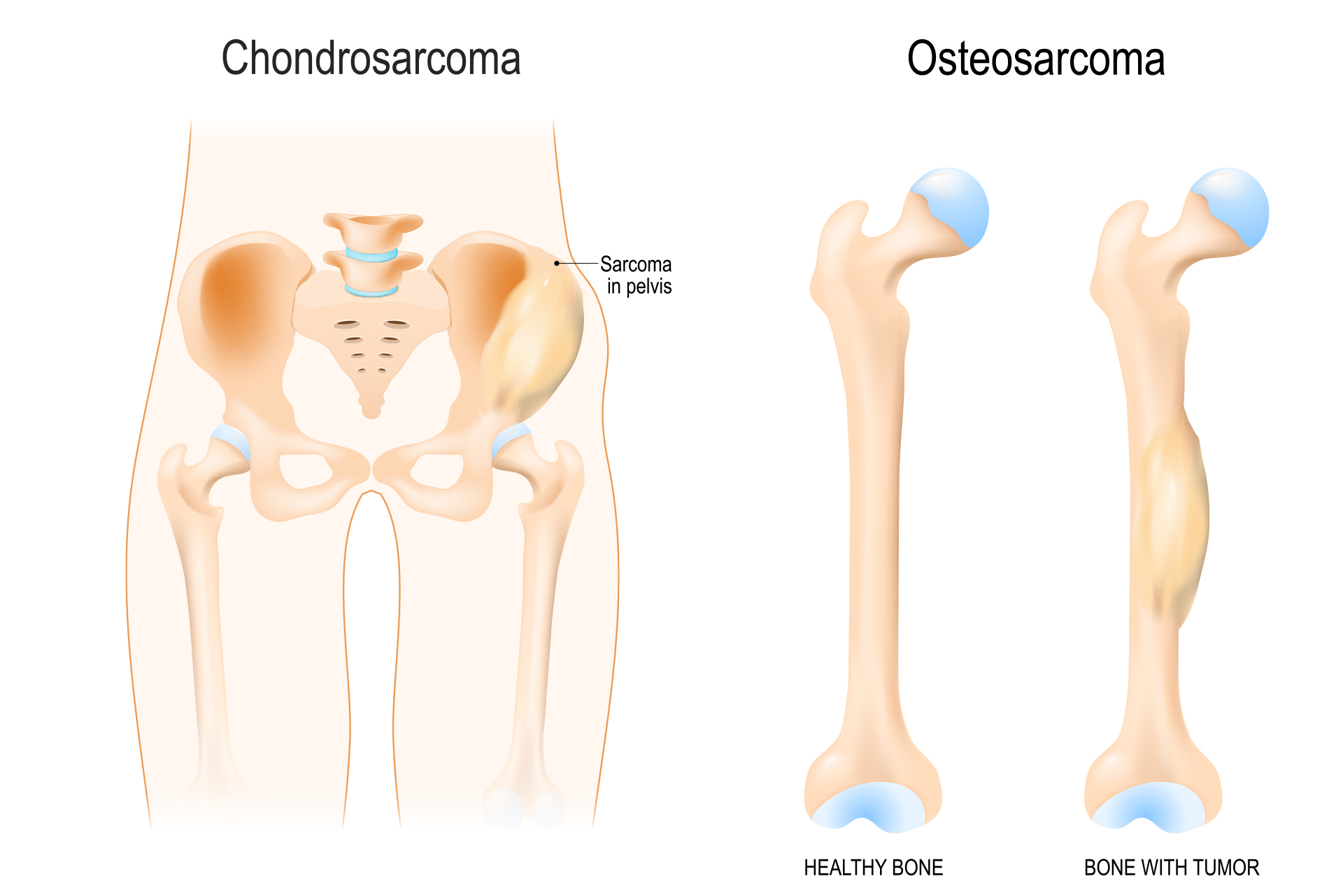 infographic with types of bone sarcoma