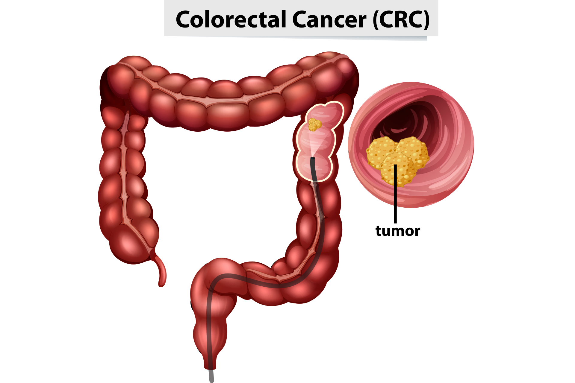 colon cancer treatment
