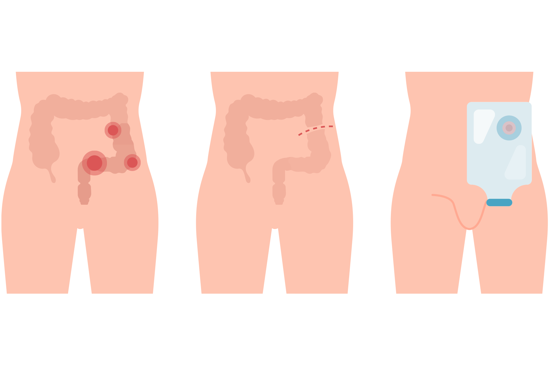 picture of a colostomy diagram