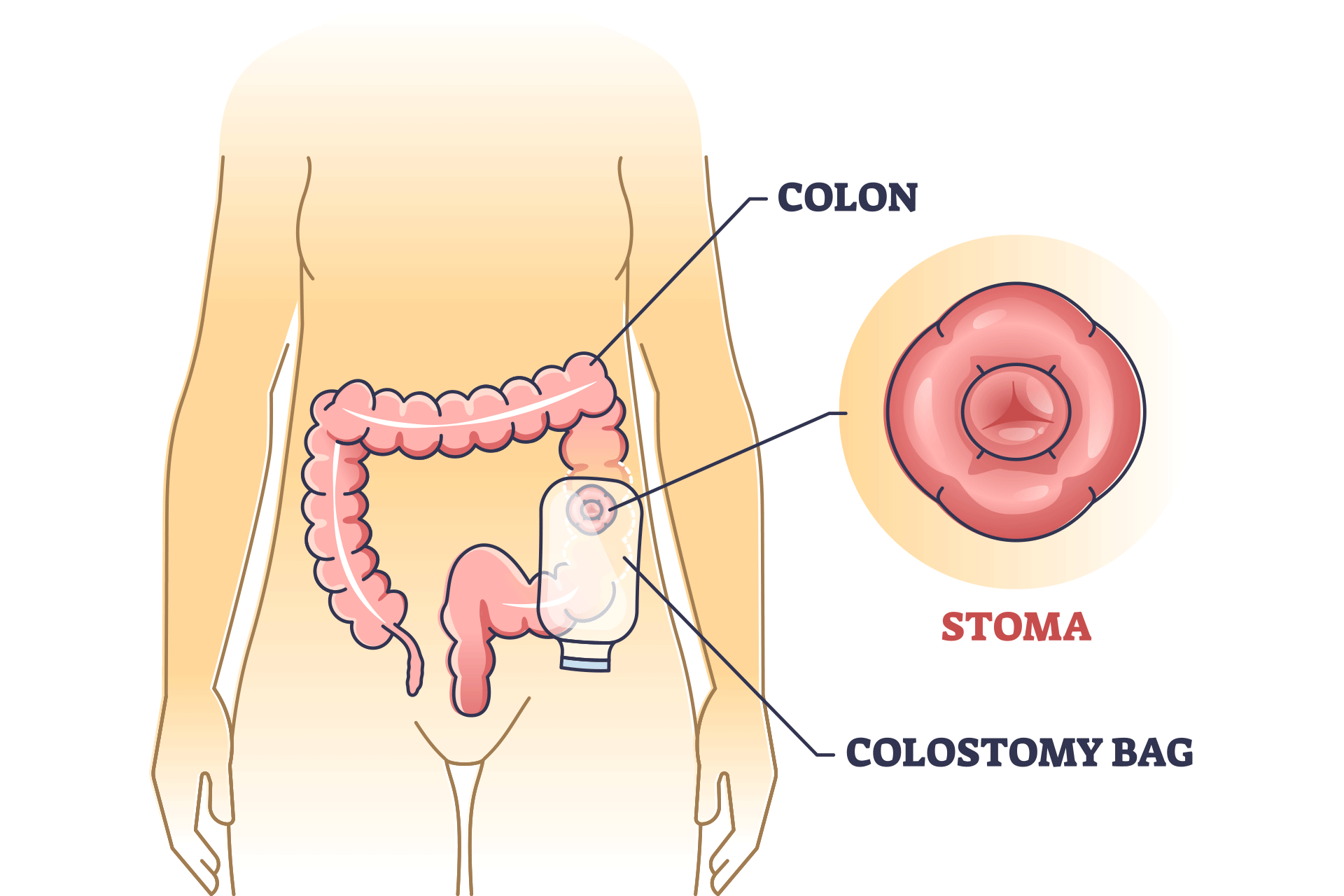 colostomy care
