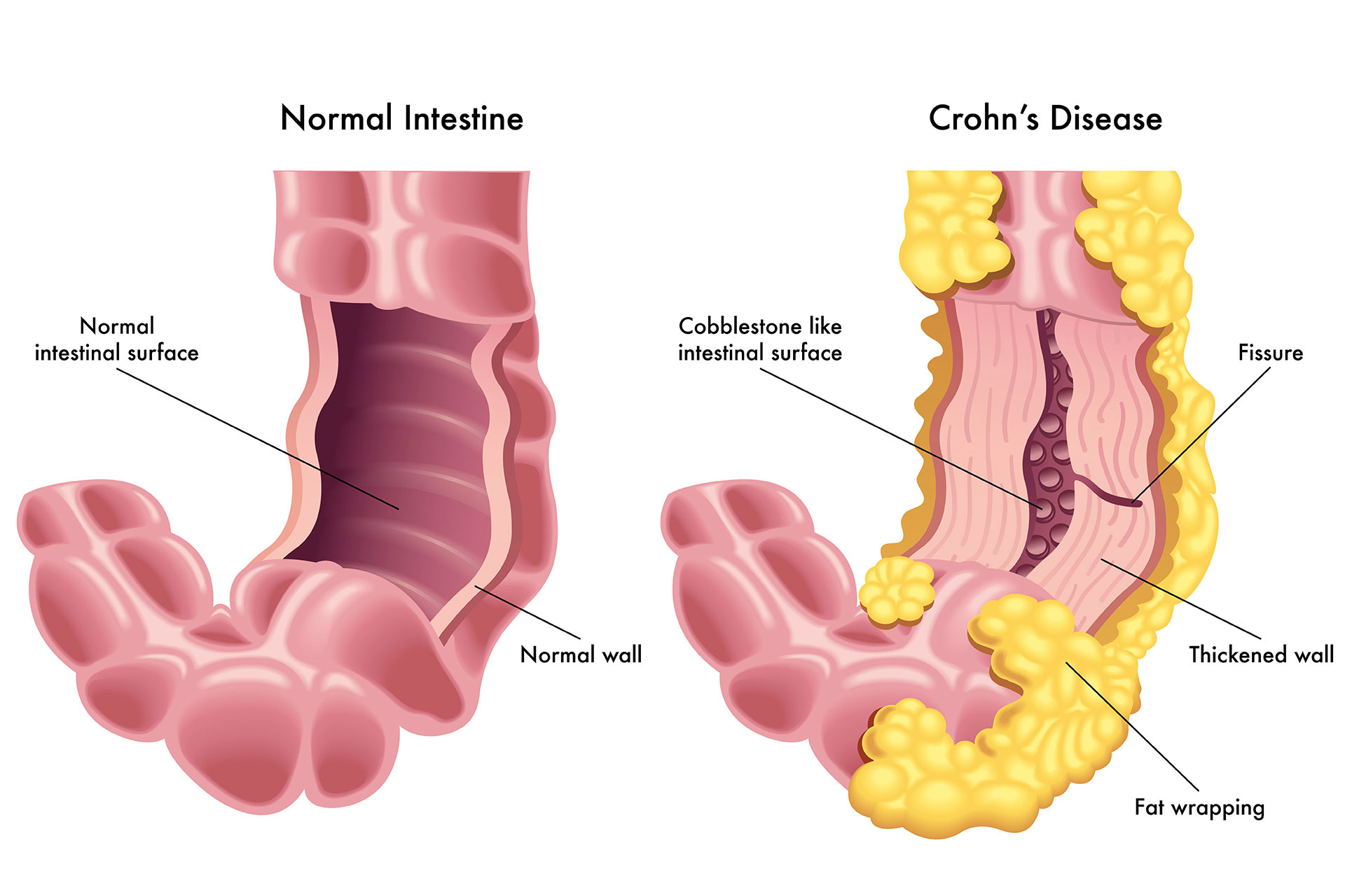 graphic showing a healthy and a crohn’s disease intestine