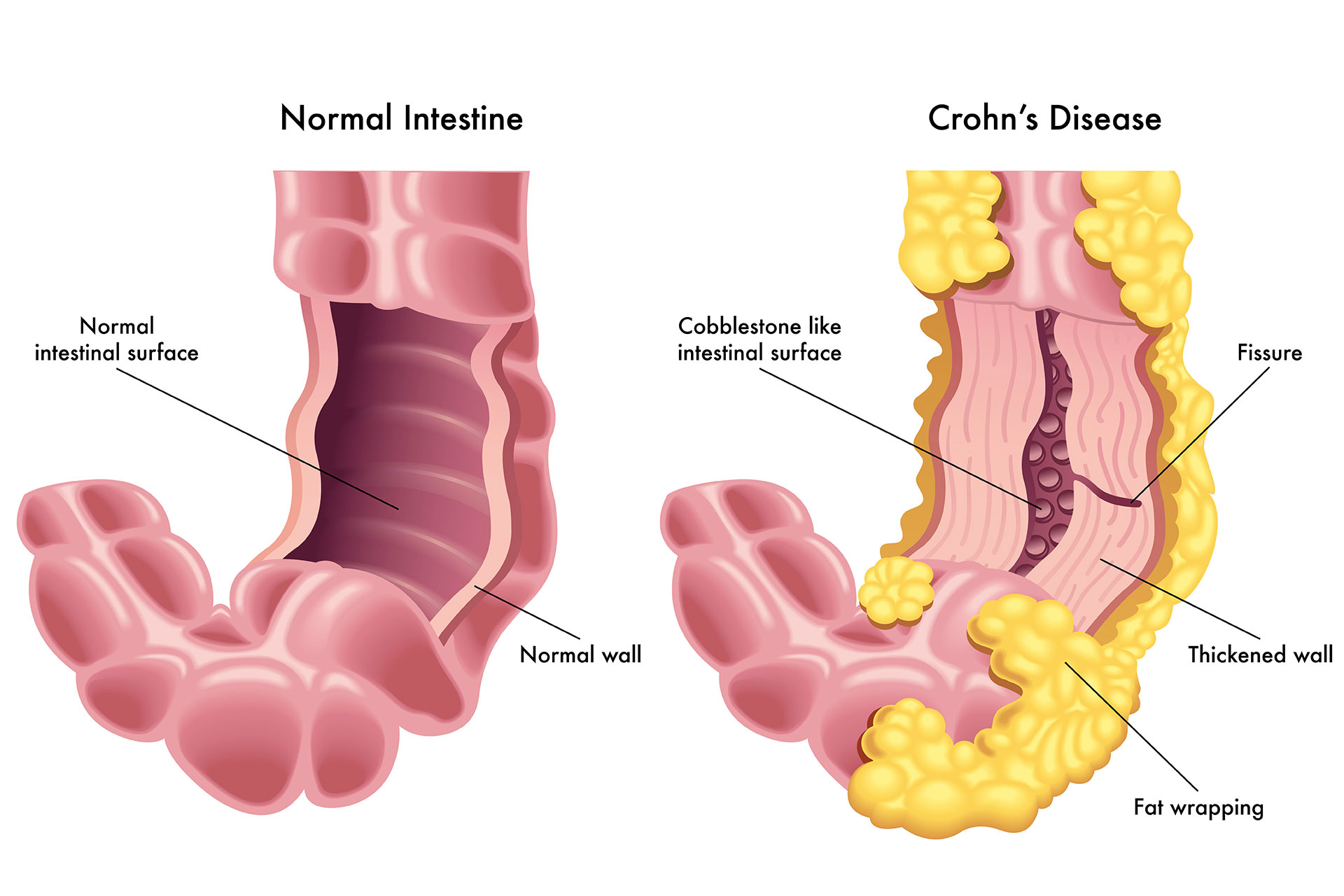 Bulto en el intestino