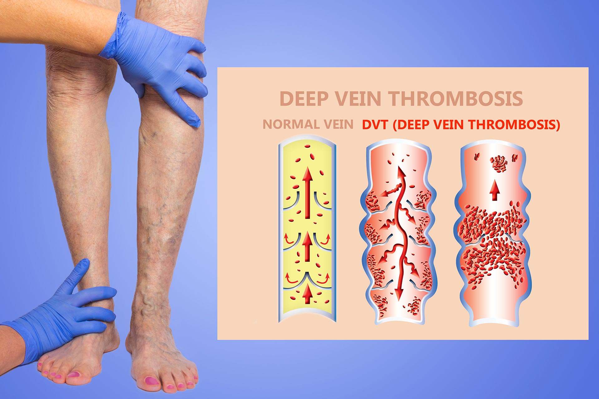 deep vein thrombosis awareness