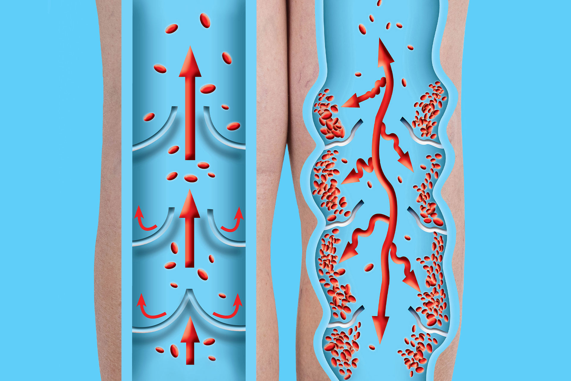 deep vein thrombosis