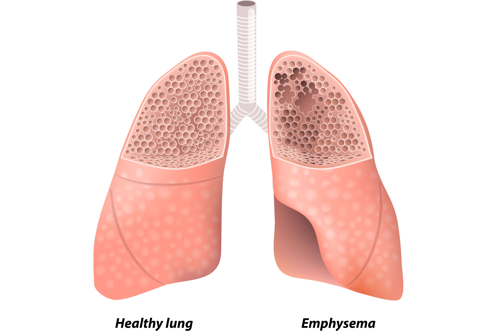 emphysema graphic 