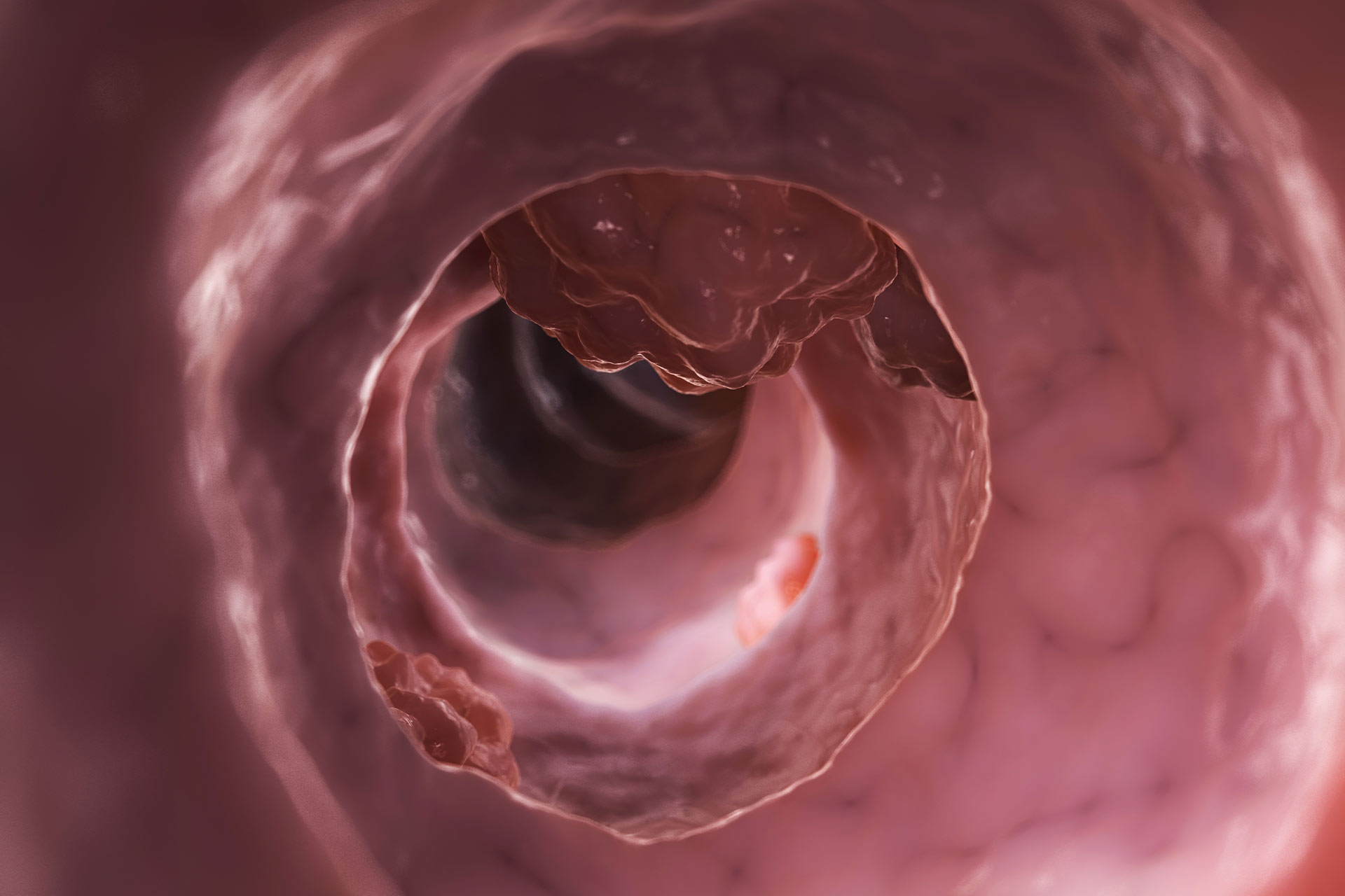 Esophageal Cancer