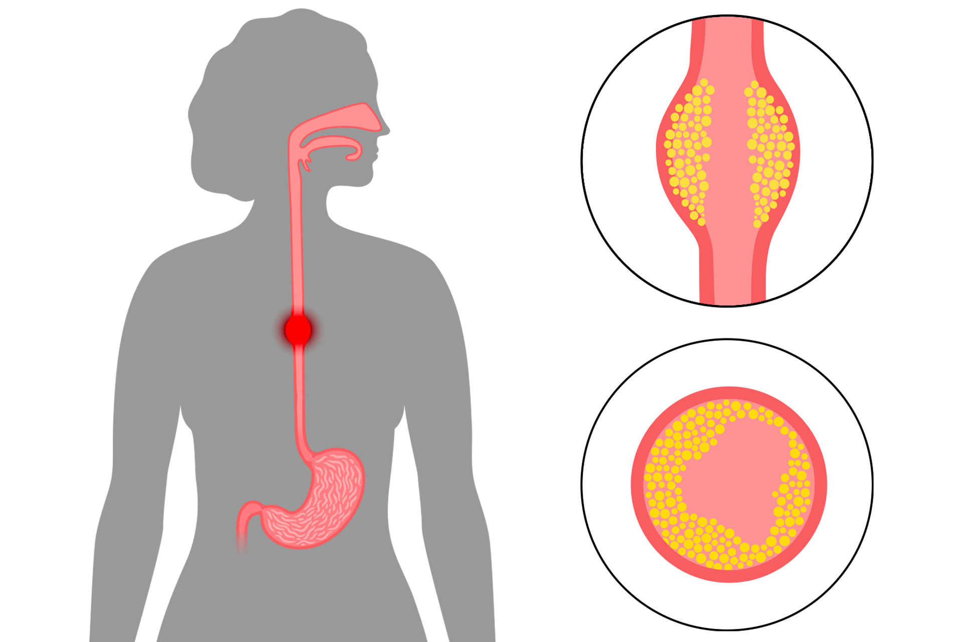 Esophageal Cancer