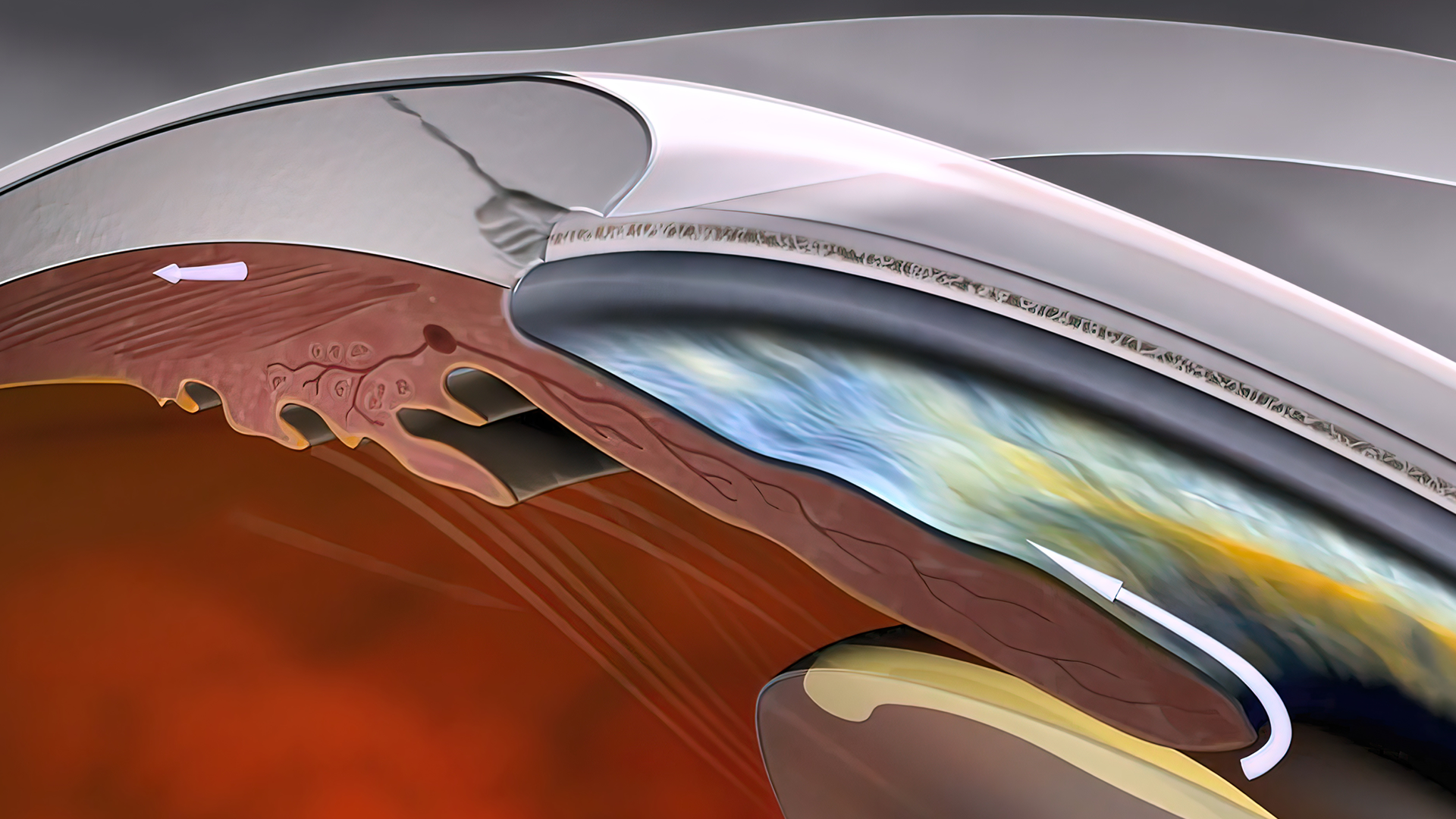 Hero-Glaucoma-Close-Up Glaucoma close up