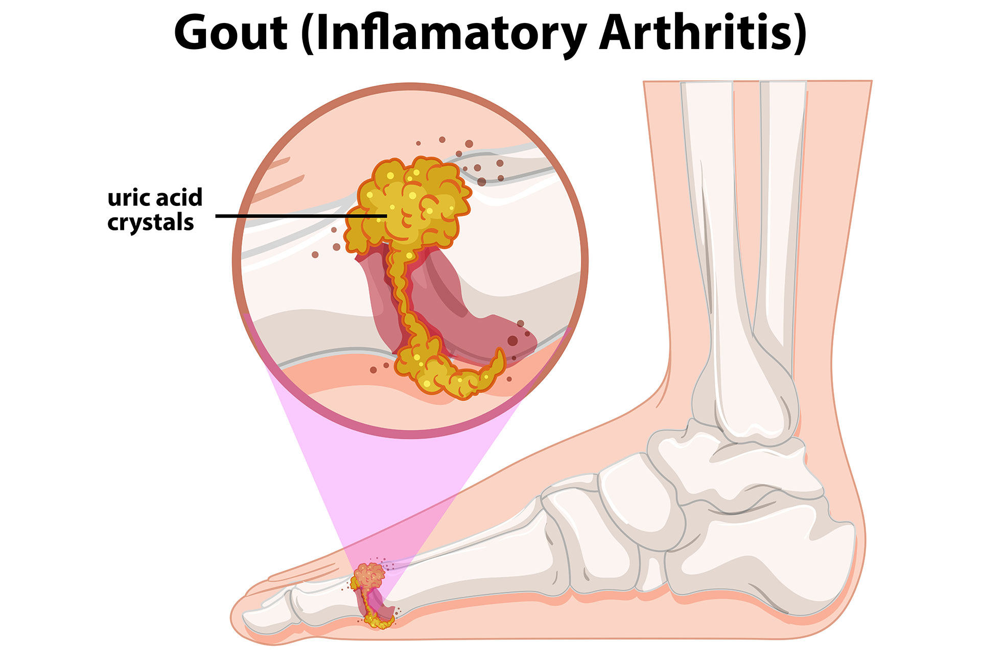 x-ray showing Rheumatoid Arthritis joints and pain