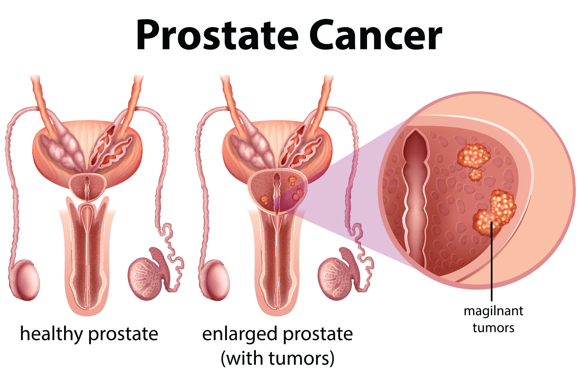 Hero-Graphic-Prostate medications to help with ulcerative colitis