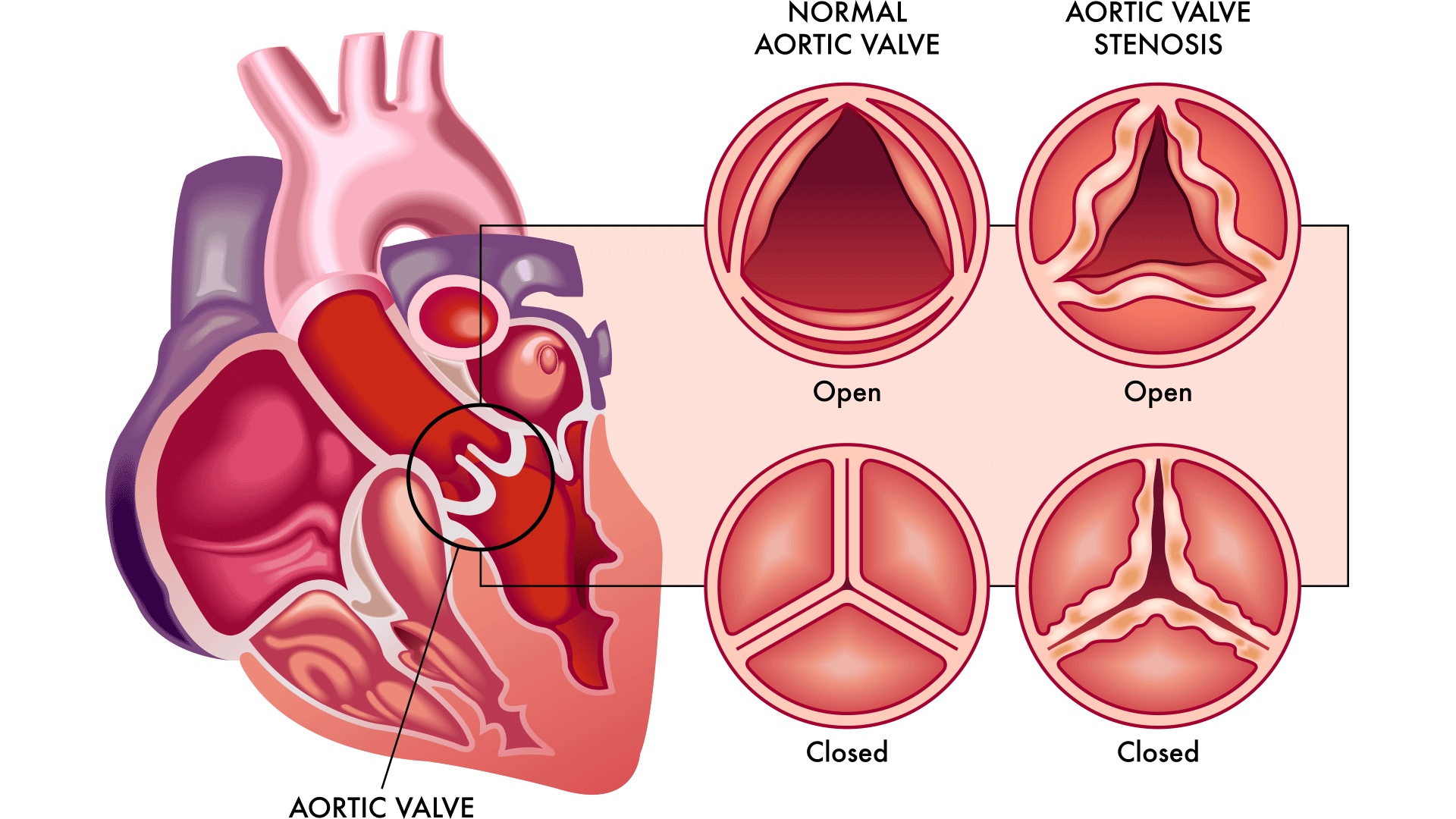 heart valve with stenosis graphic