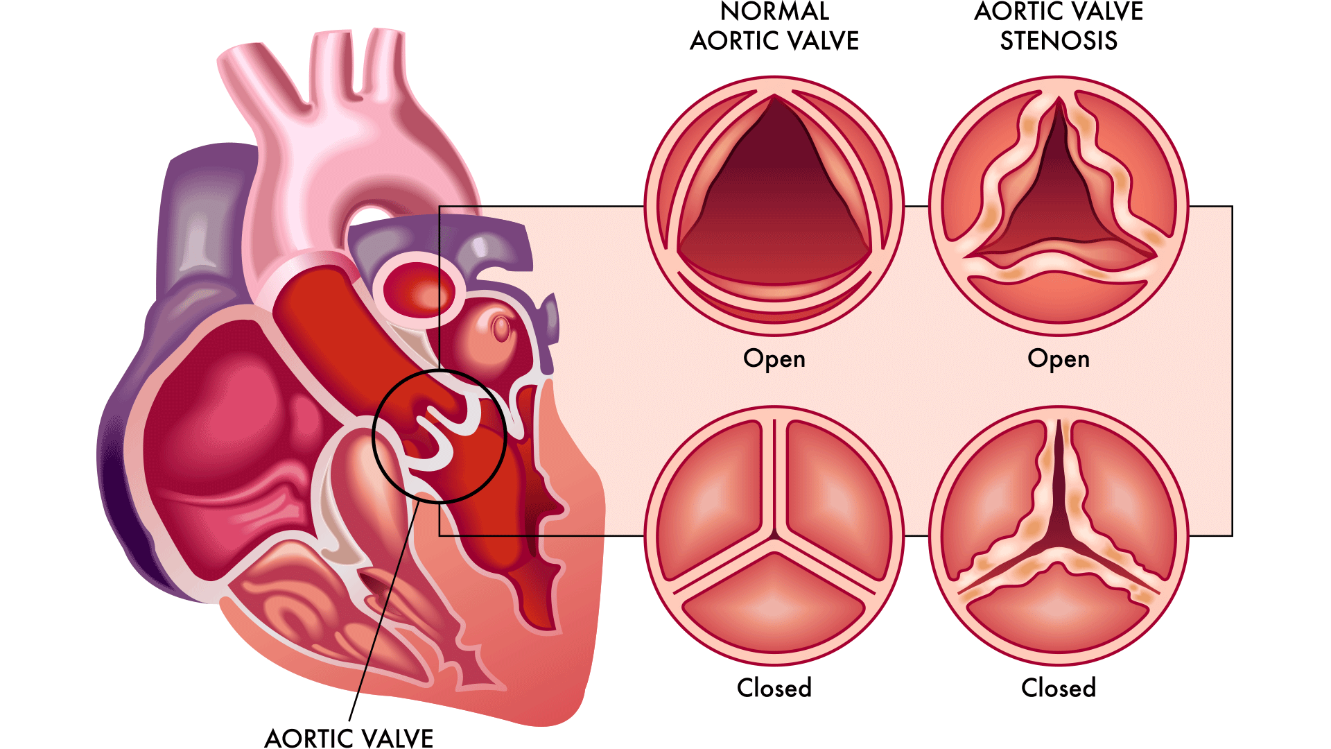 Hero-Heart-Valve-Open-Closed-Graphic heart valve with stenosis graphic