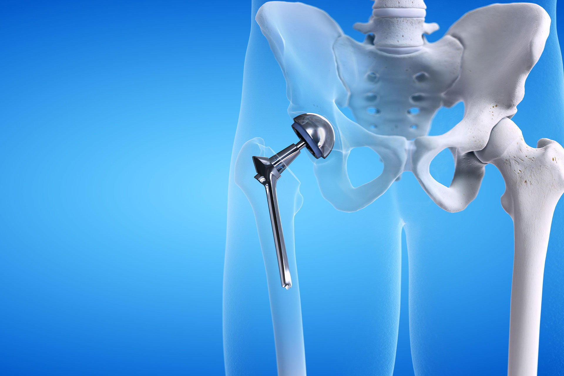 Hip replacement surgery