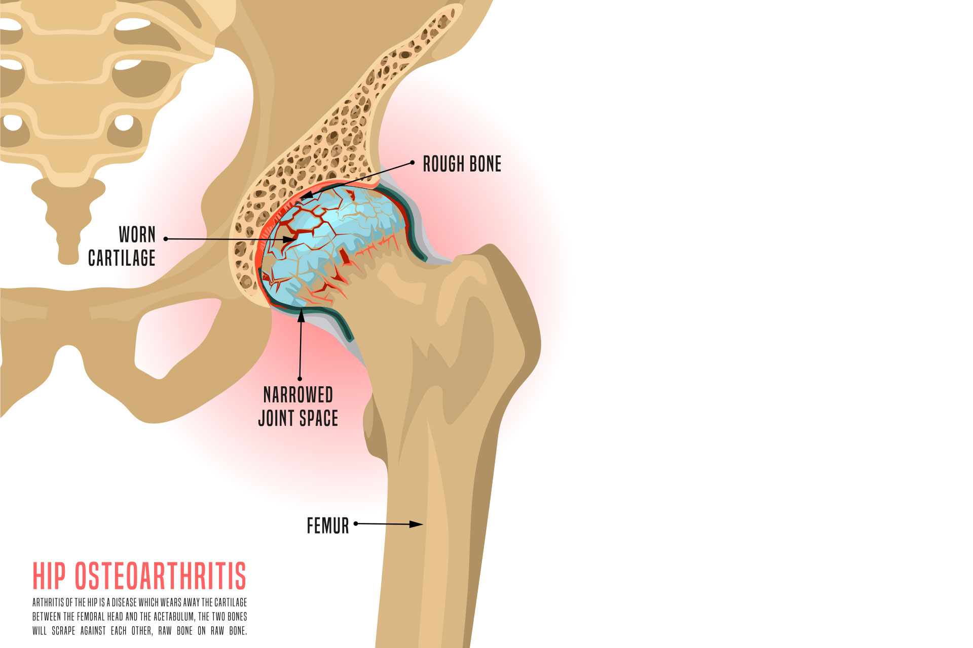 Hip joint graphic