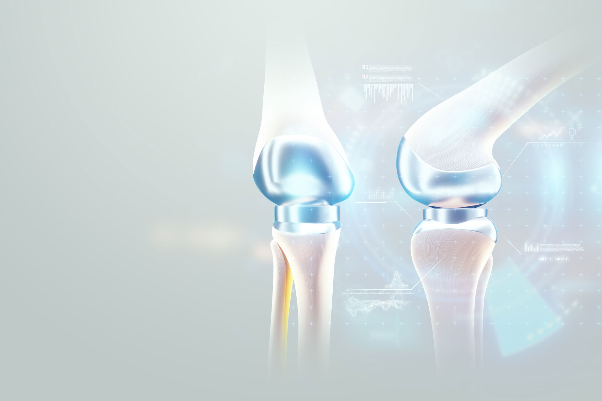 knee replacement graphic