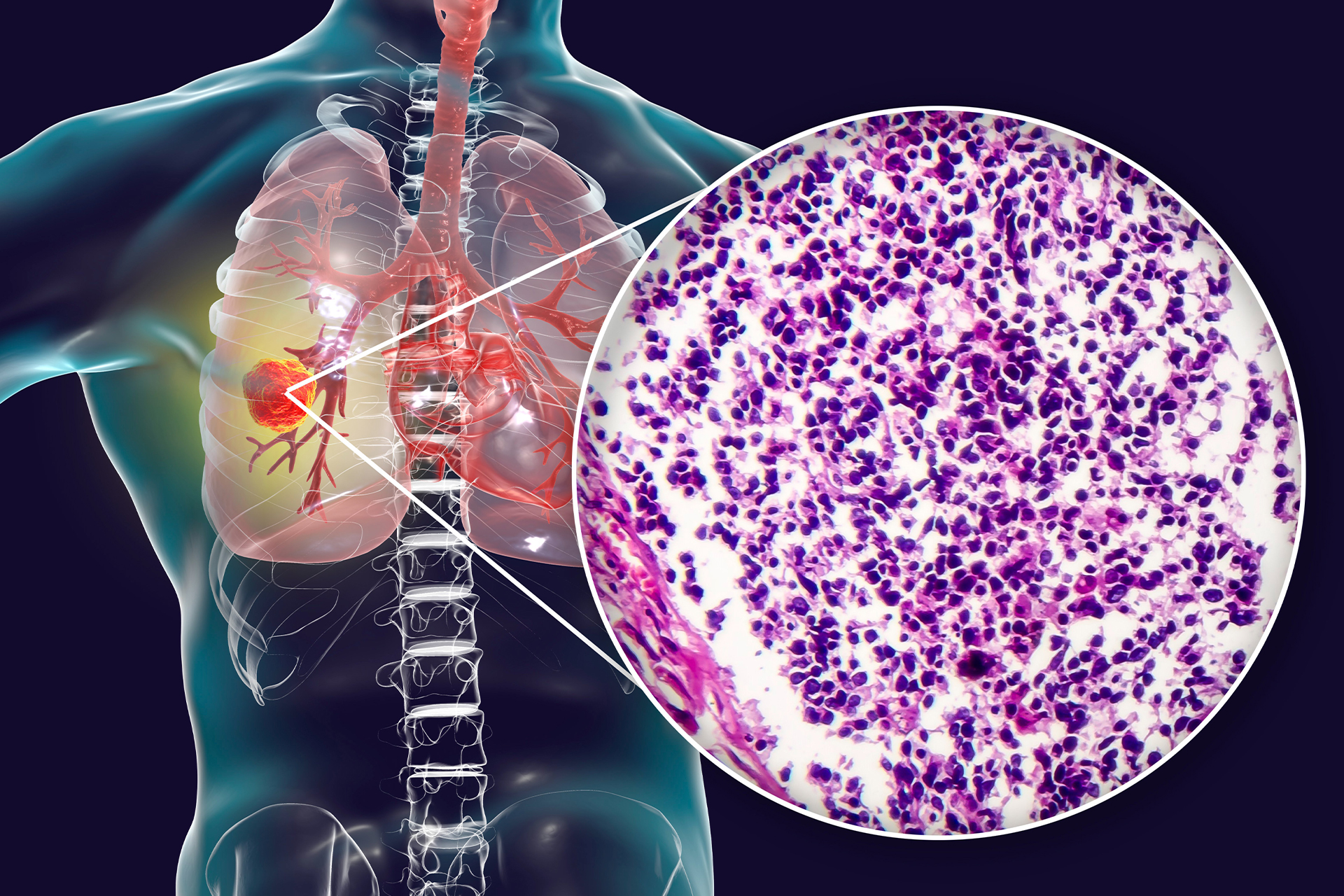 Lung cancer graphic