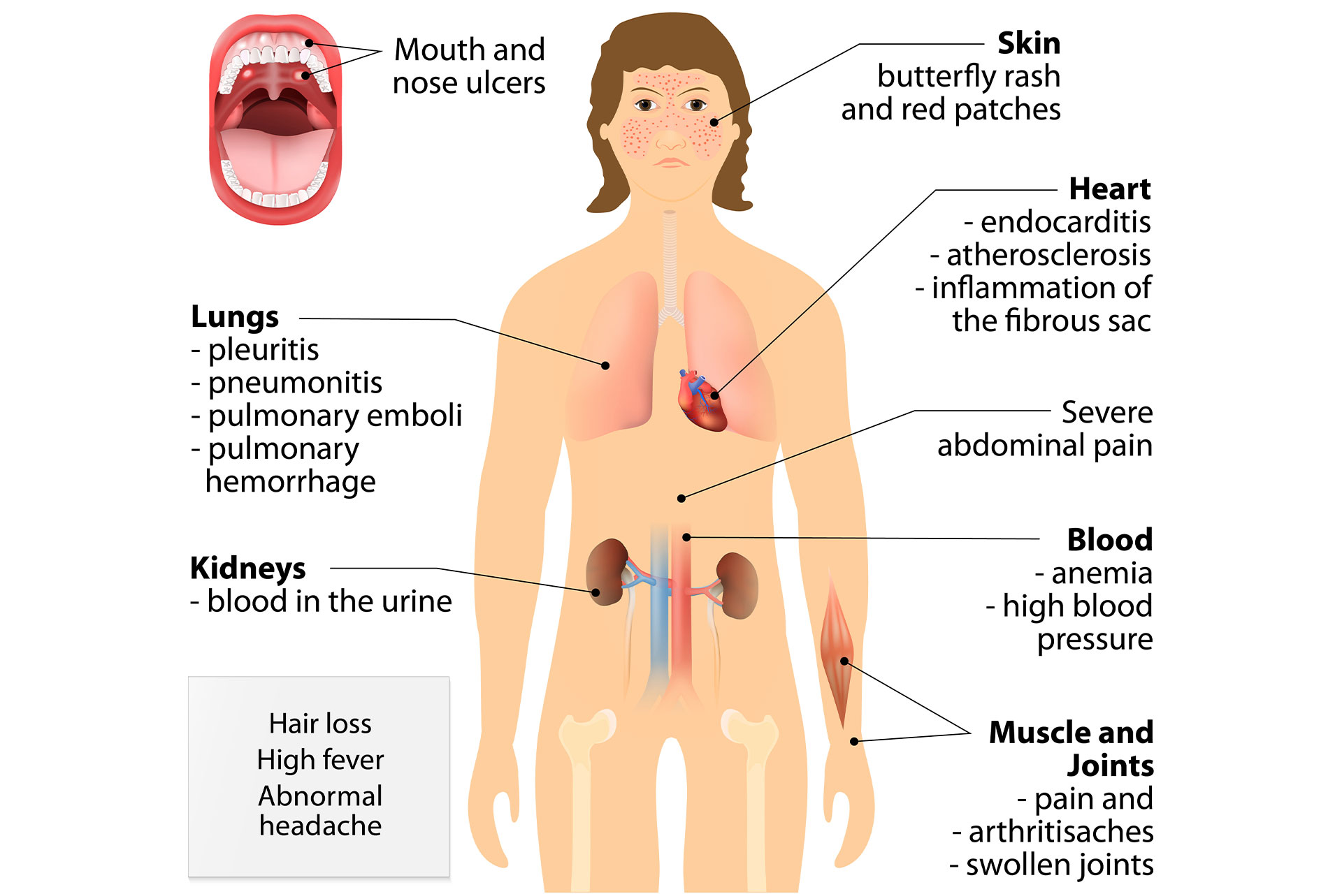 graphic showing a Lupus diagnose