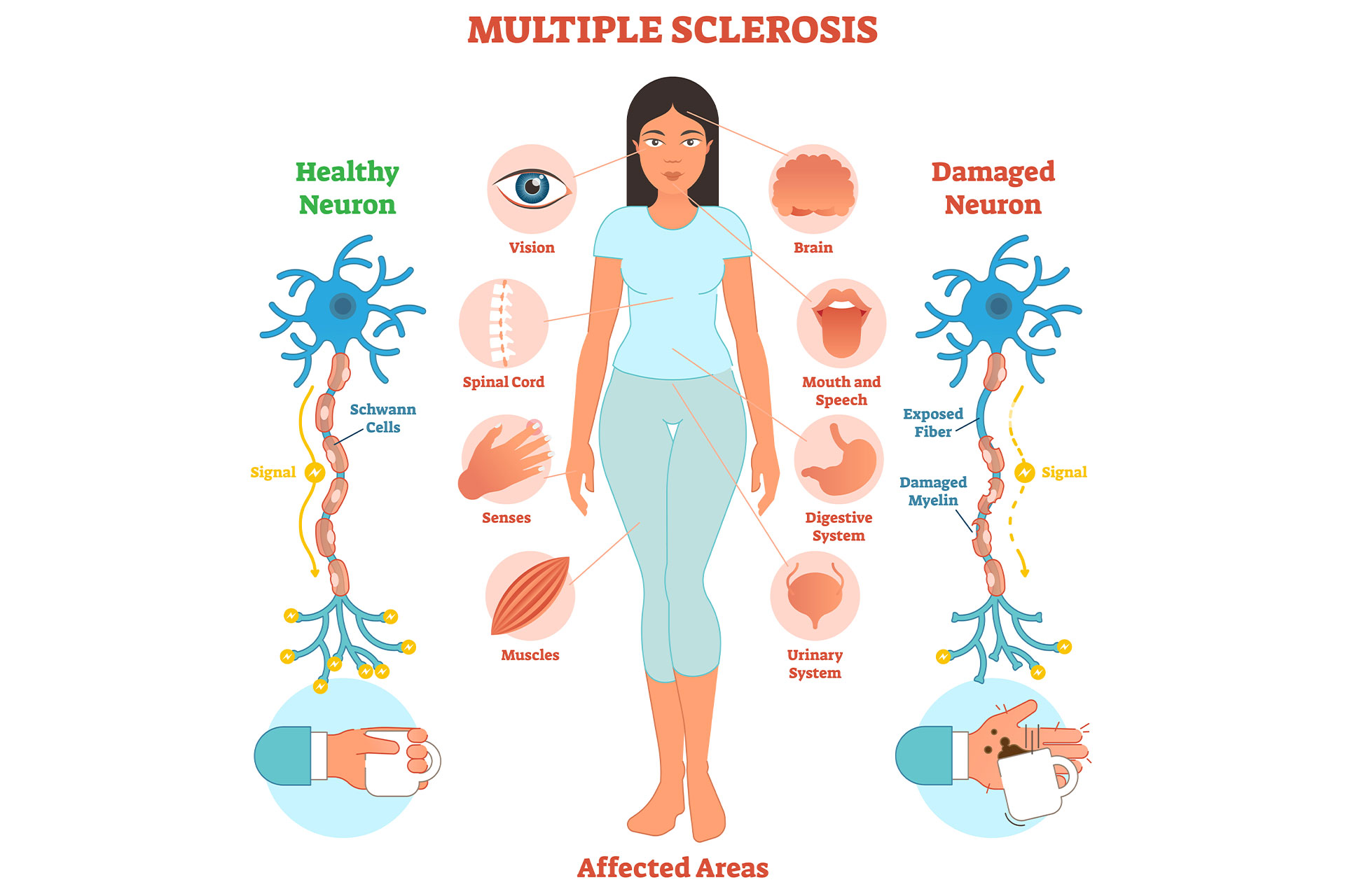 Graphic showing a woman with rheumatoid arthritis