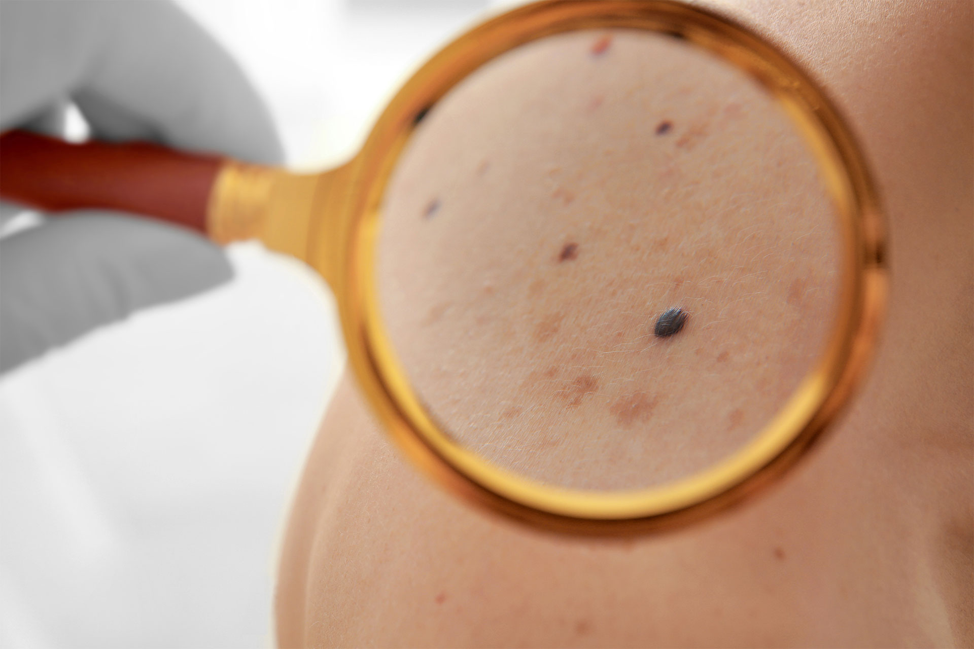 Melanoma evaluation