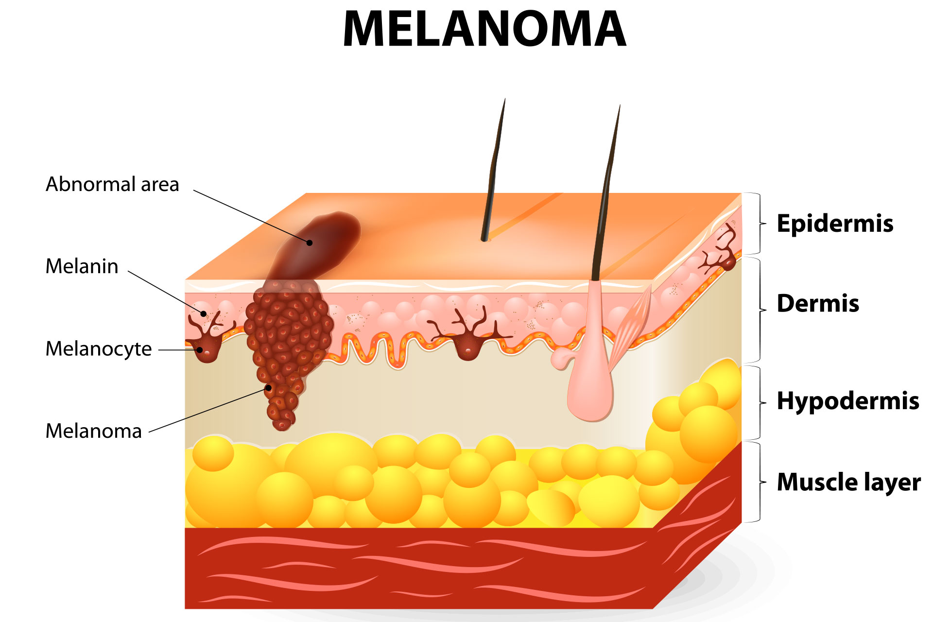 melanoma graphic