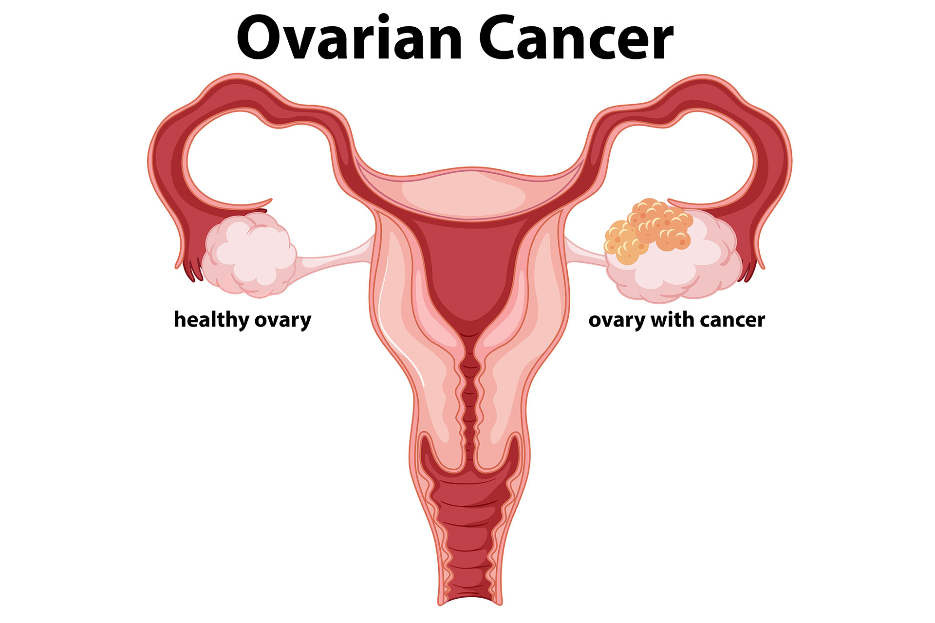 diagram of cervical cancer 