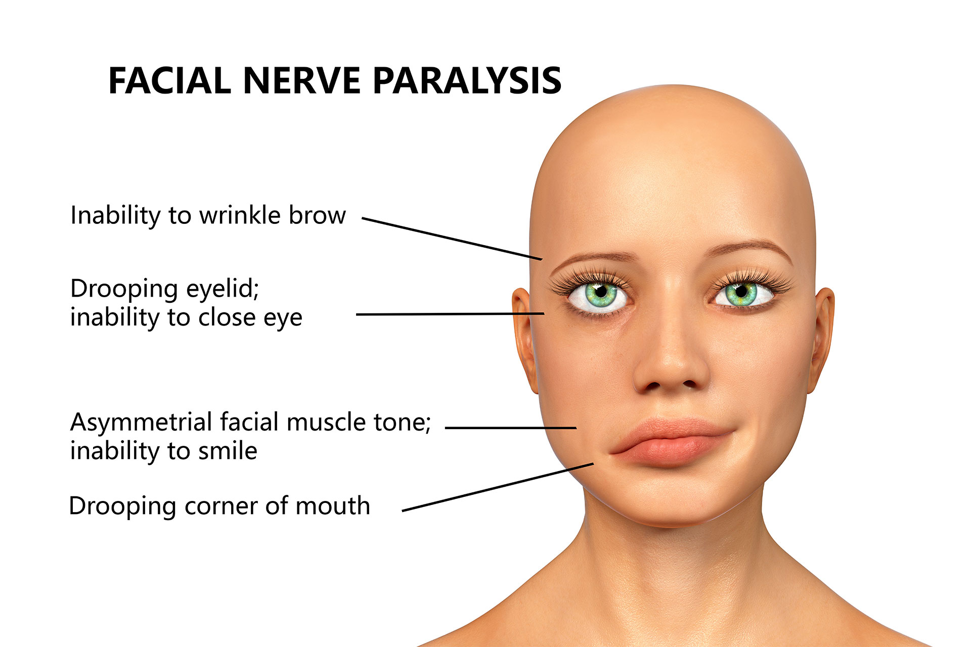 Face paralysis diagram