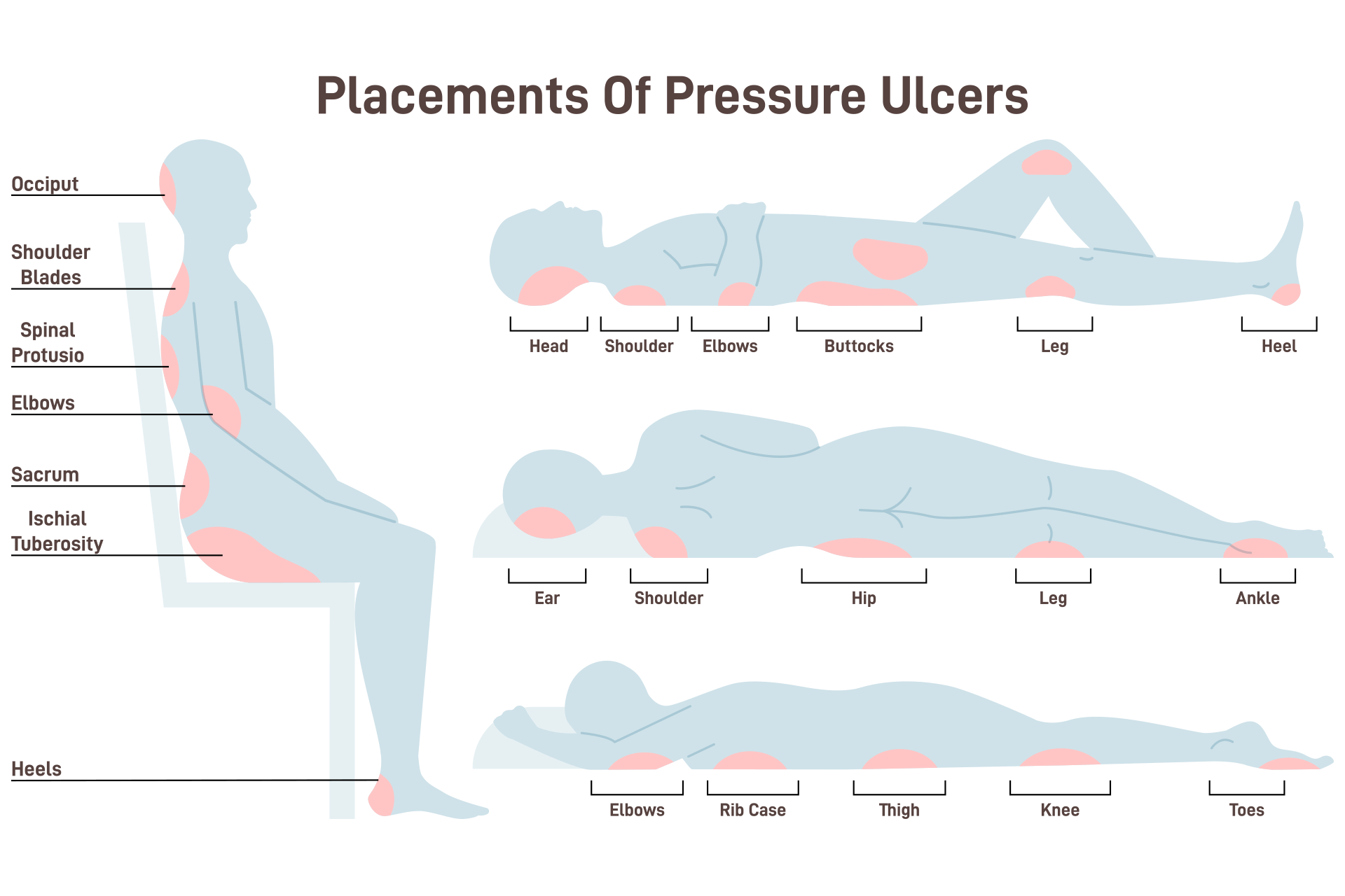 pressure sore placements