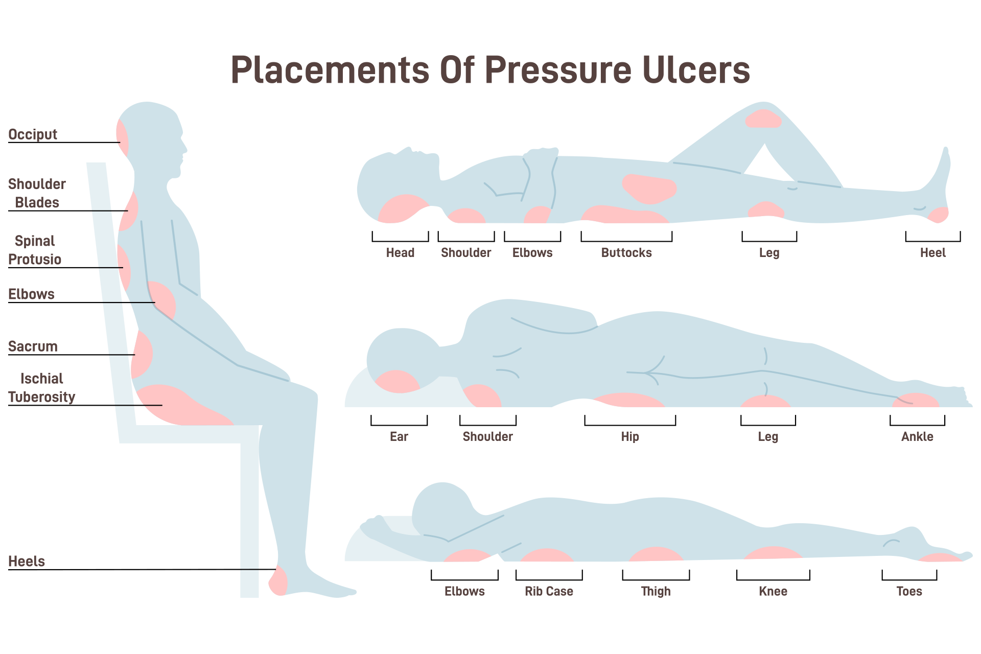 Assessment and Documentation of Pressure Ulcers | SpringerLink