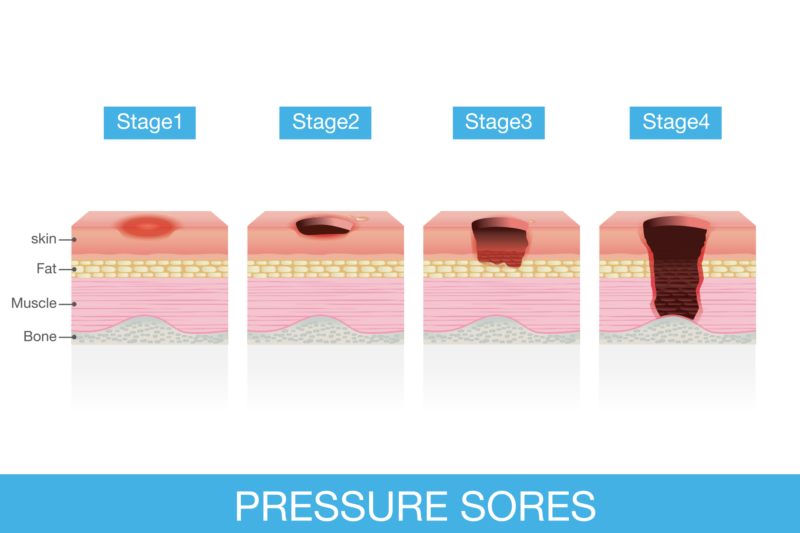 BEDSORES PRESSURE ULCERS visual data 3