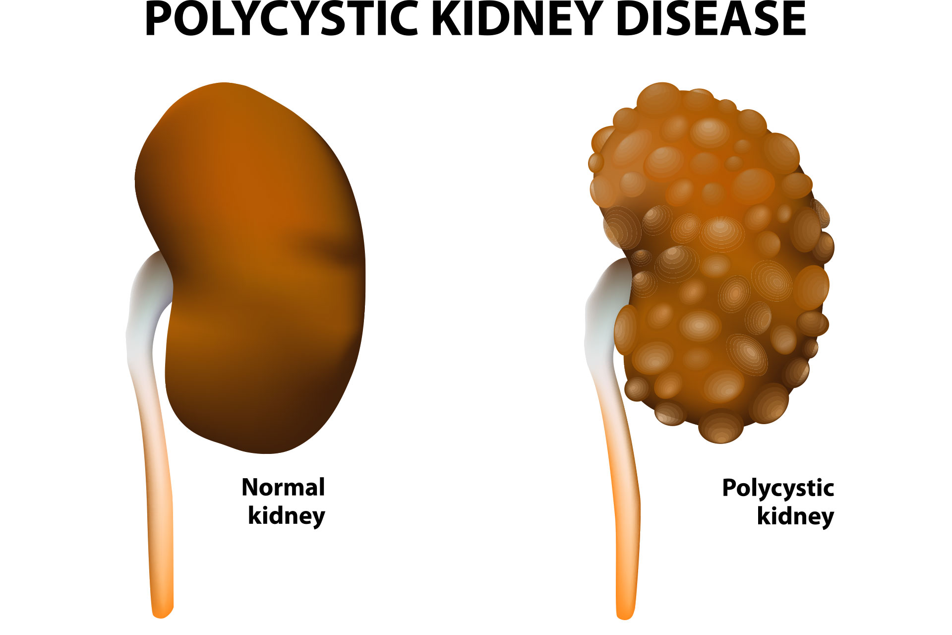 Renal kidney failure