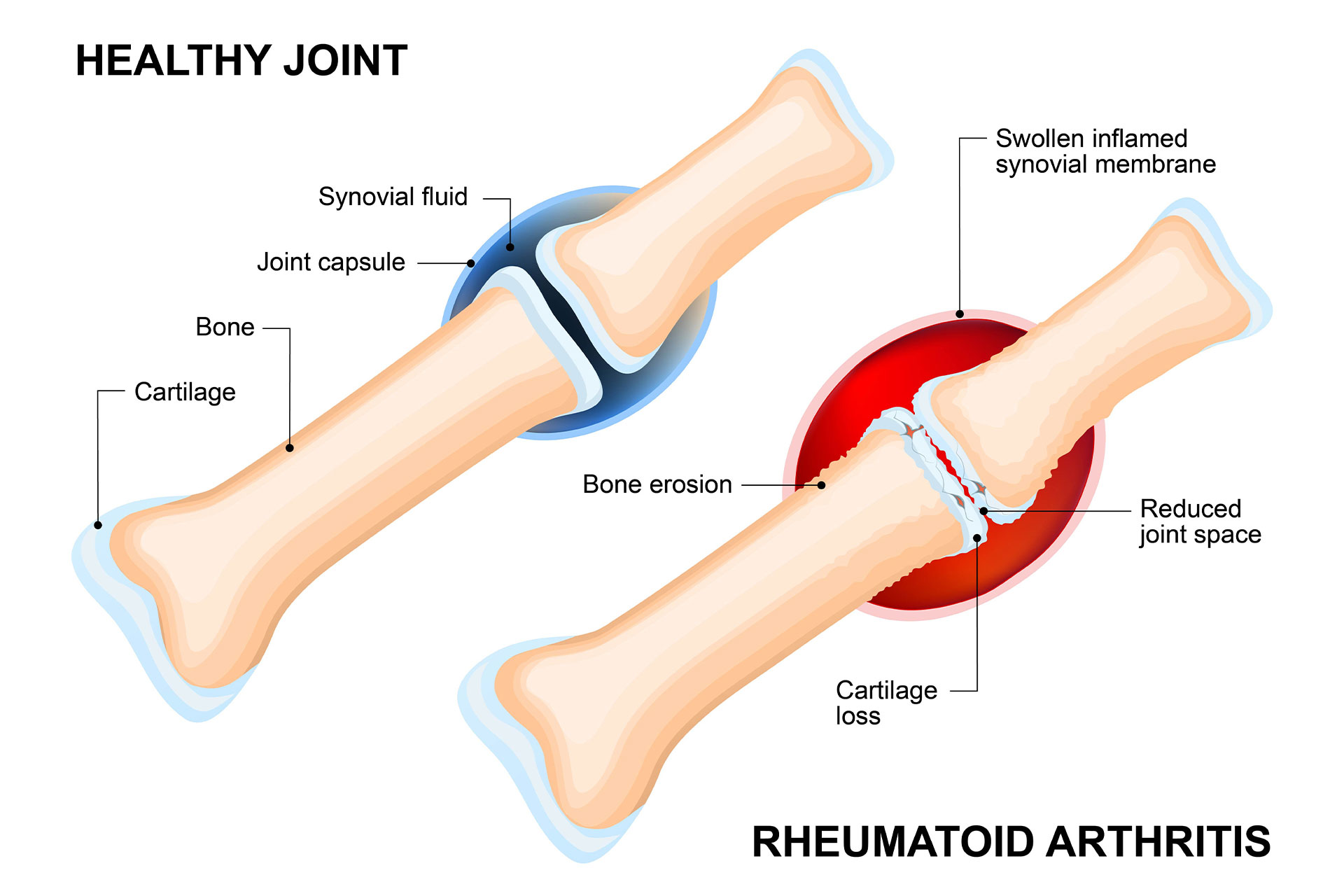 graphic showing a healthy and a Rheumatoid Arthritis joint