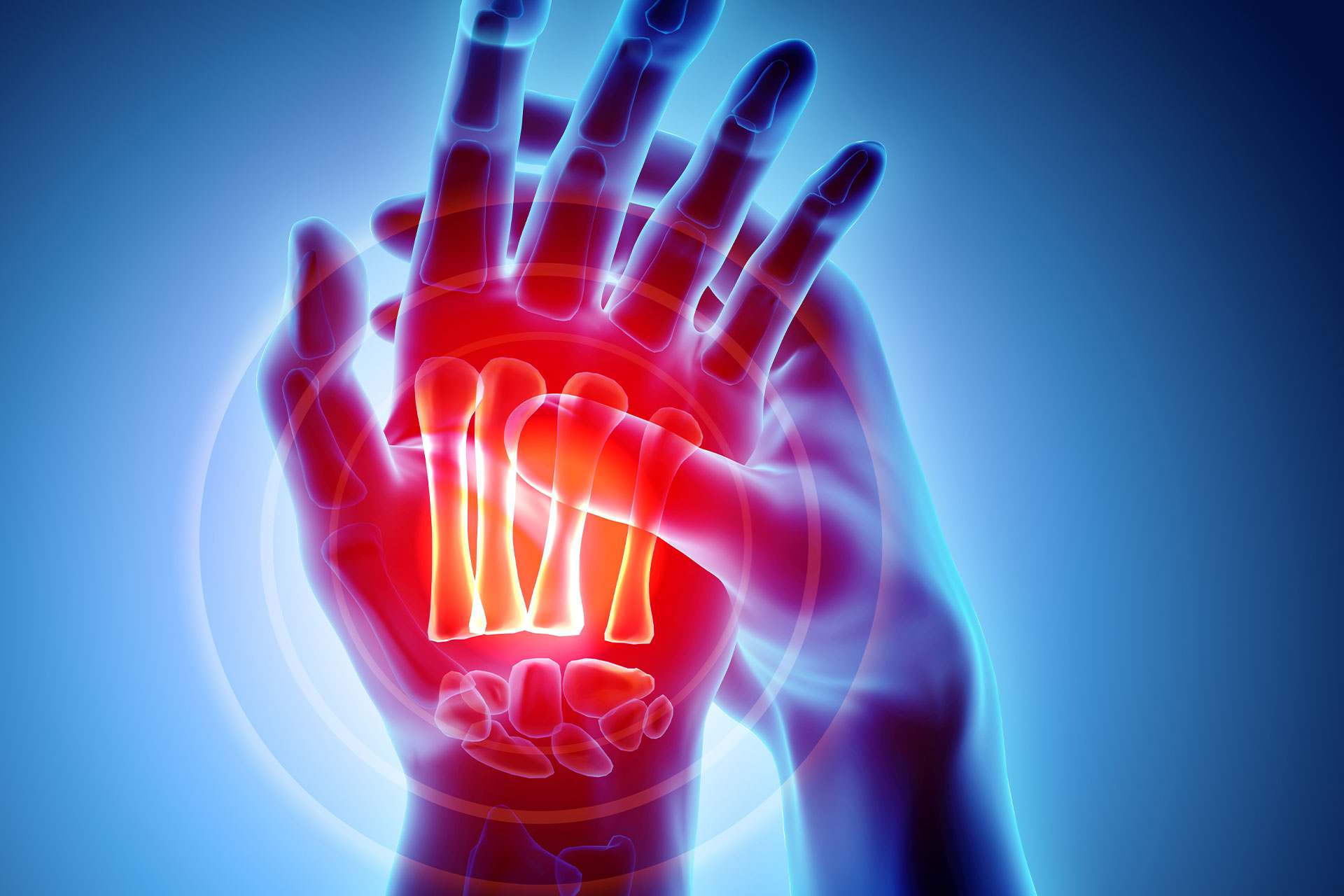 x-ray showing Rheumatoid Arthritis joints and pain