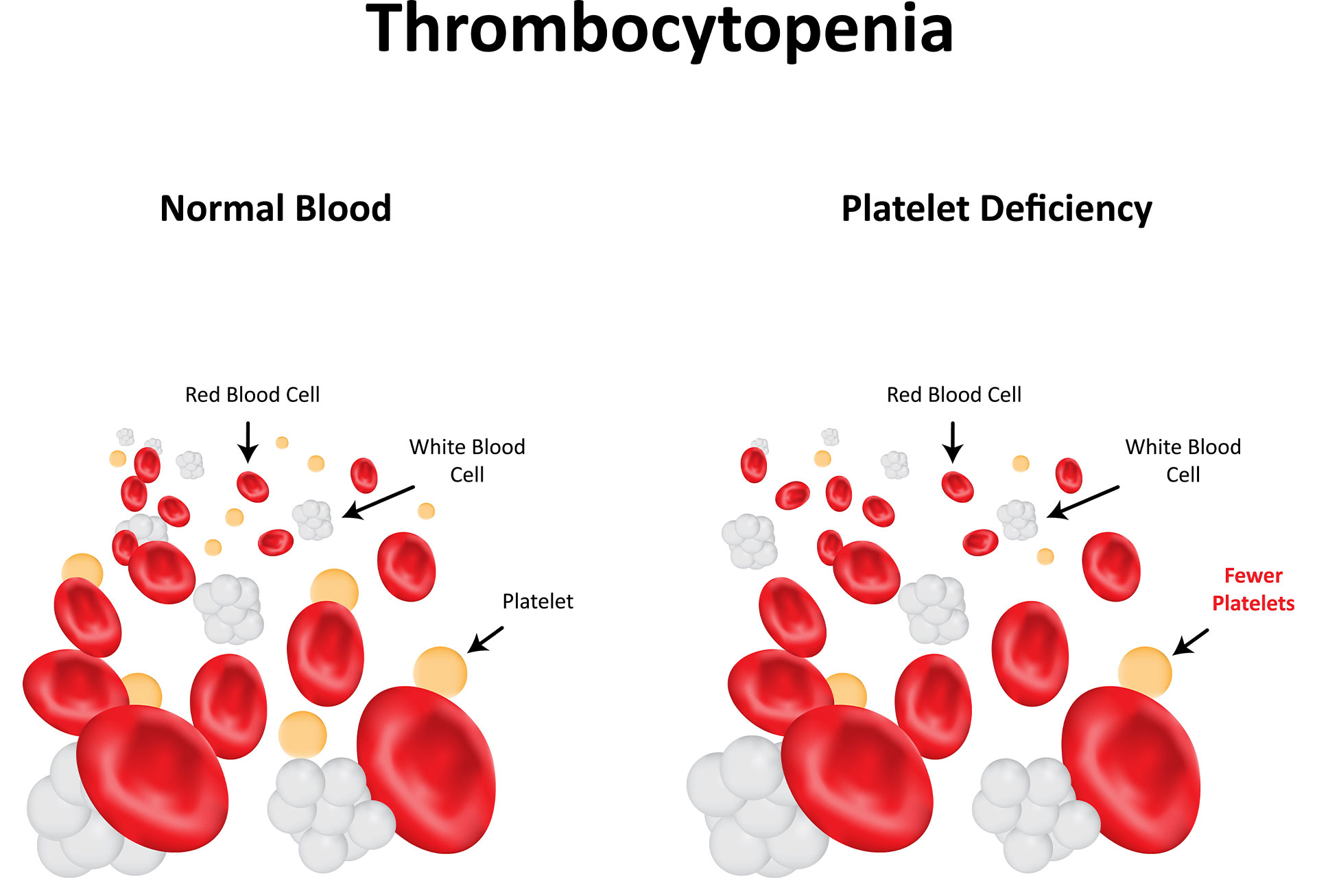 blood pallet graphic for thrombocytopenia