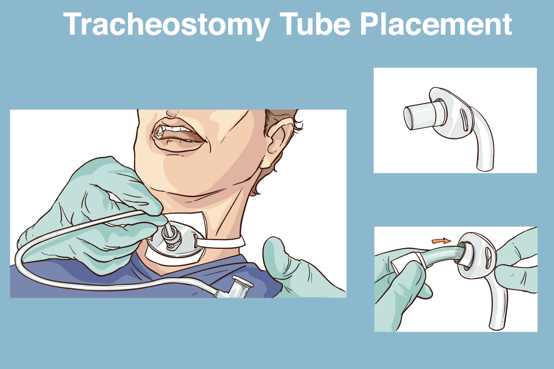 Hero-Tracheostomy-Tube-Replacement female have crohn’s pain