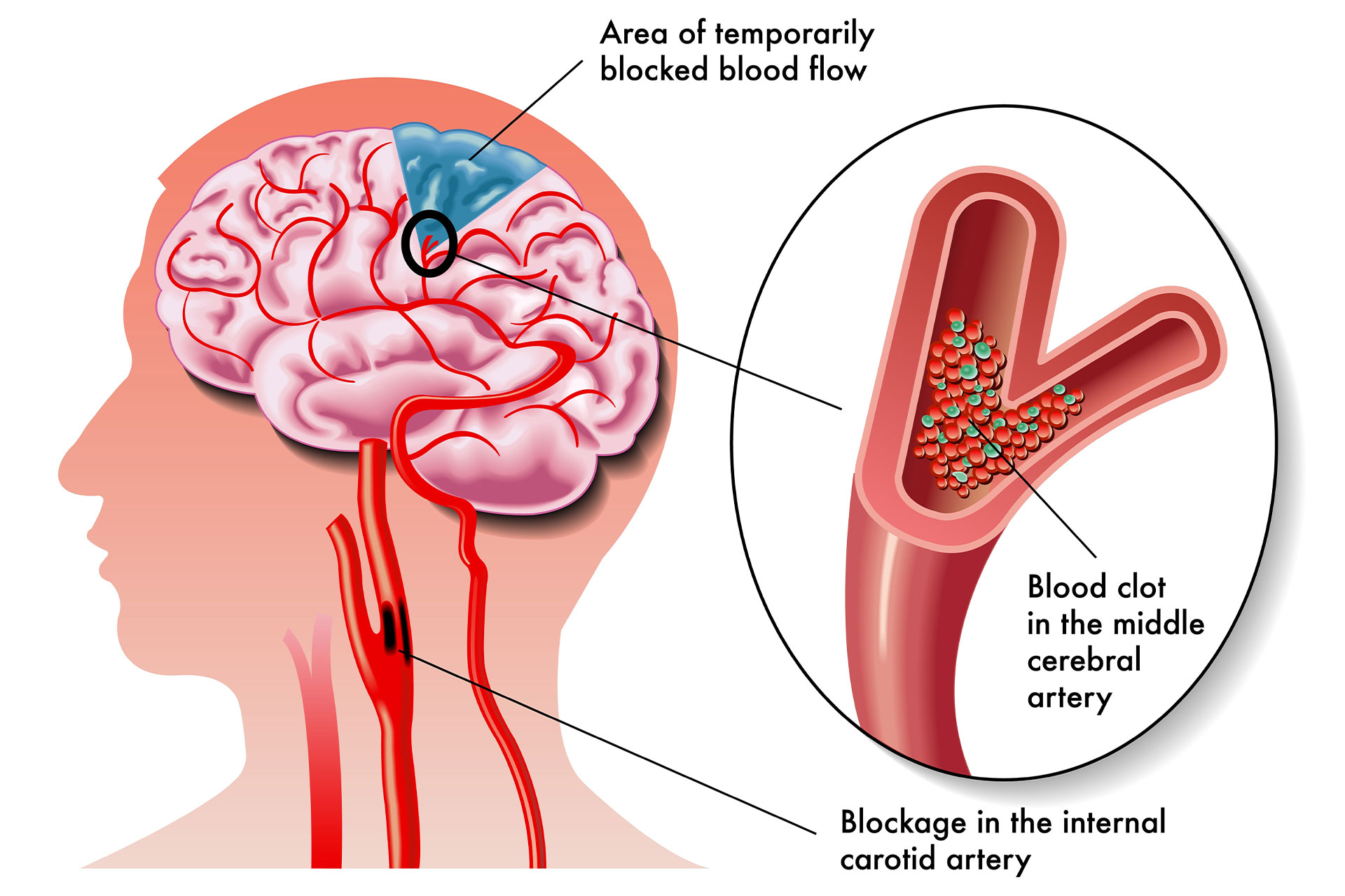 picture of a patient with brain blood clot