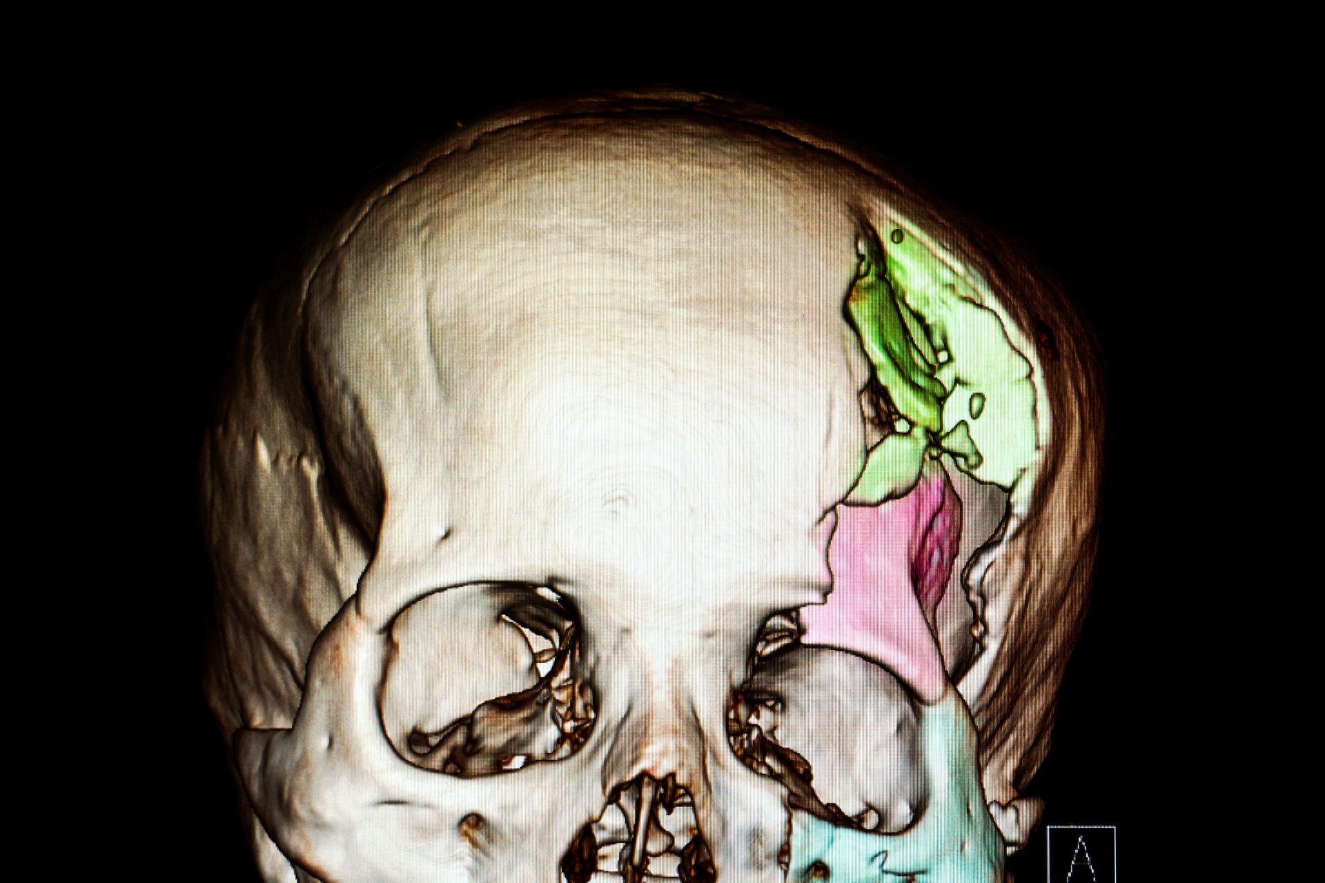 TBI MRI