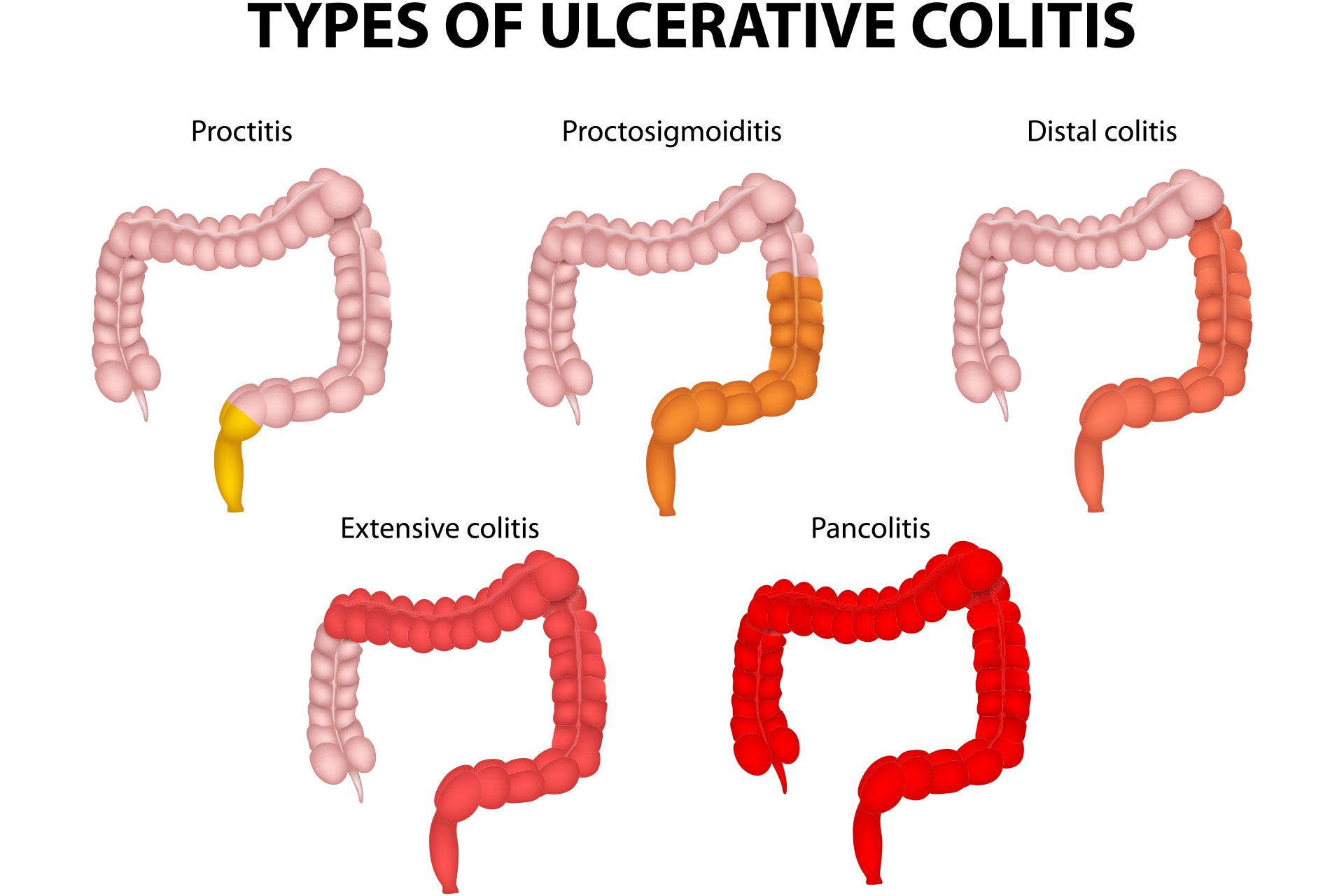 Types of colitis graphic