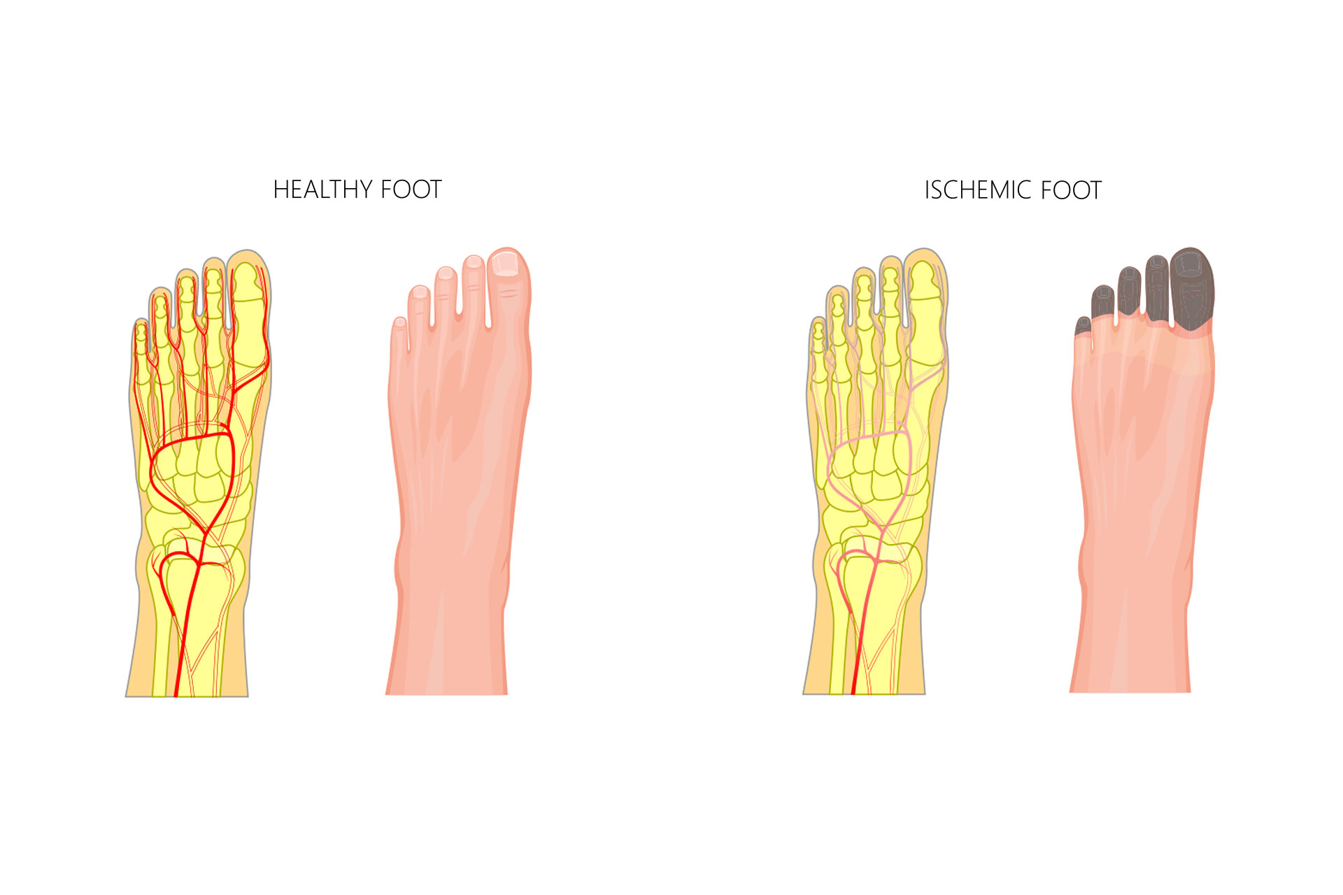 healthy foot vs. ischemic foot