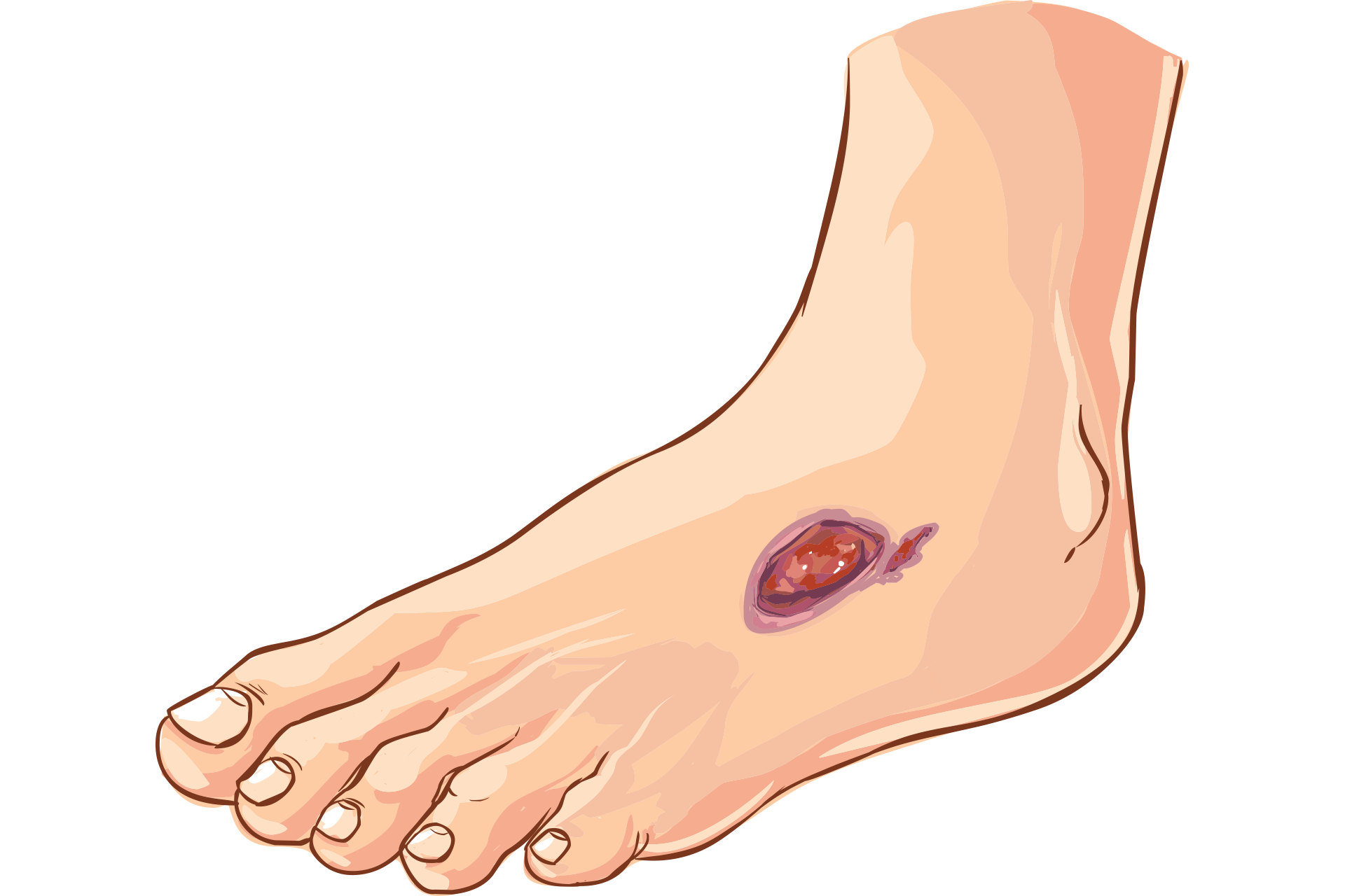 graphic of arterial ulcer